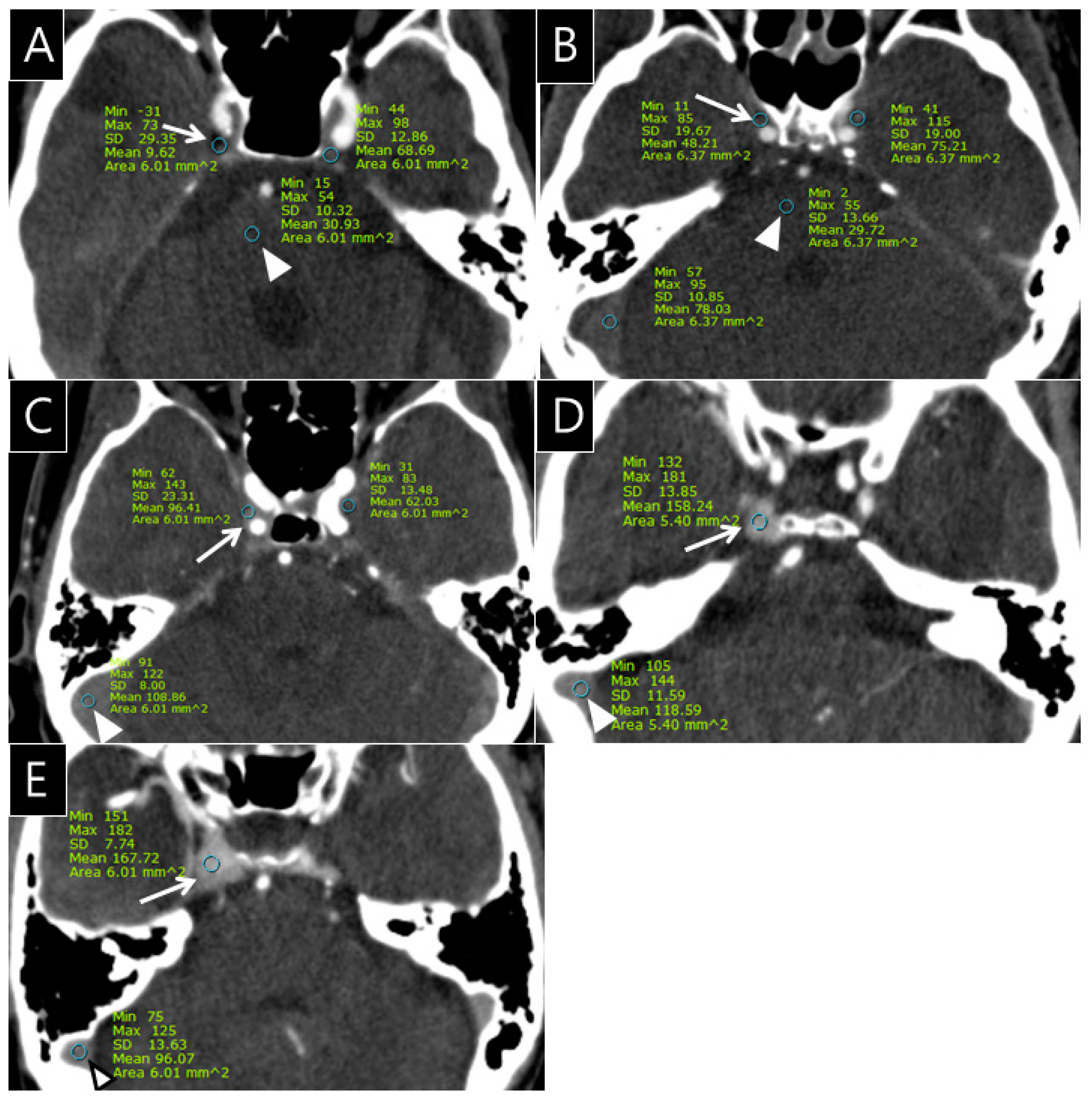 脳神経外科  Cavernous Sinus Cavernous Sinus Syndrome | SpringerLink