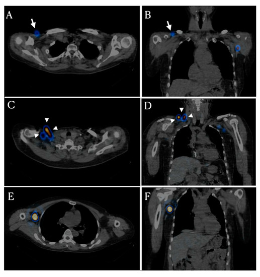 lymph nodes in malay