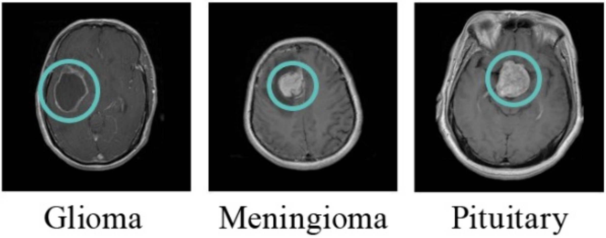 A Novel MRI Diagnosis Method for Brain Tumor Classification