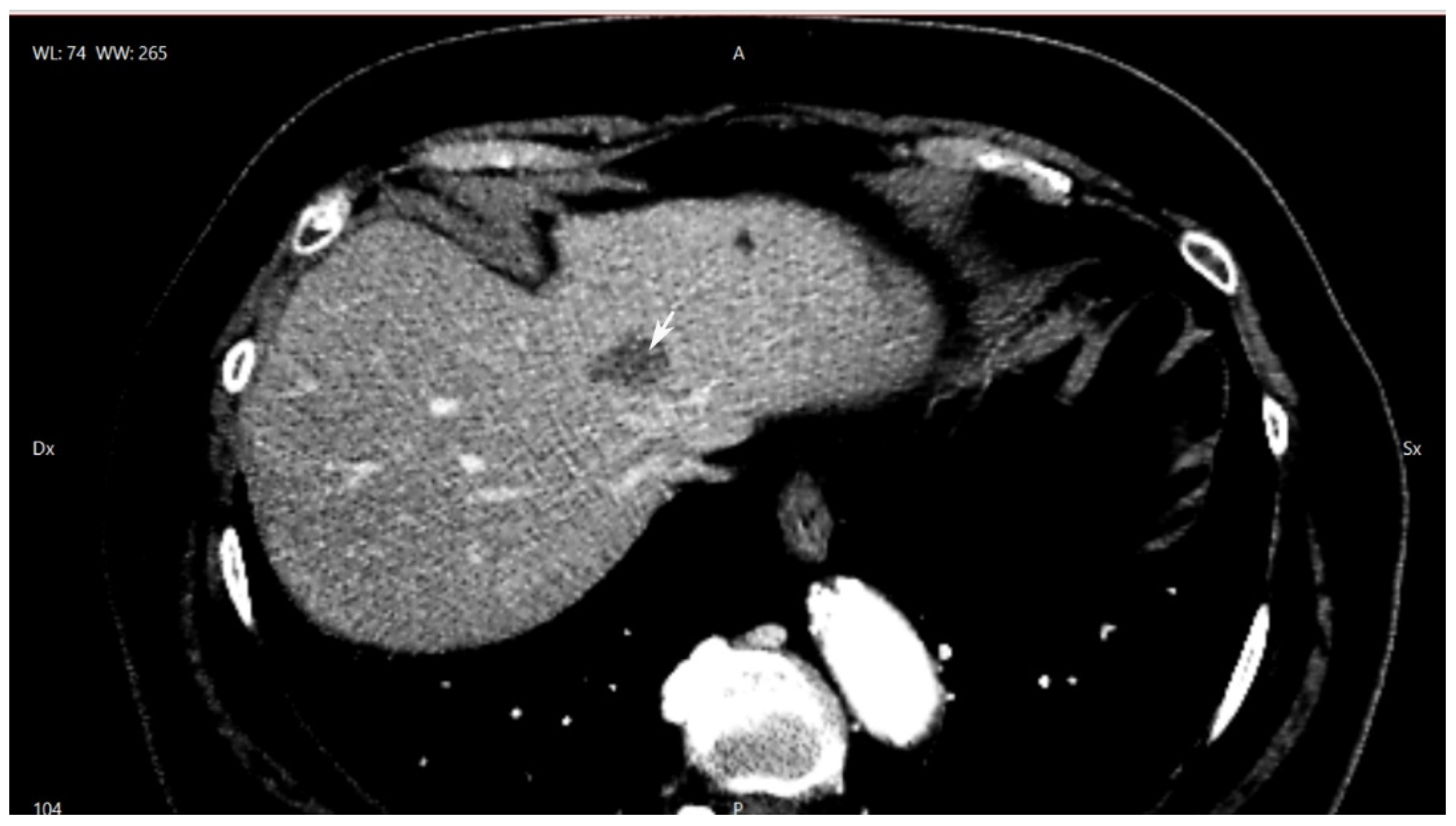 THE TEXTBOOK OF SYSTEMATIC LIVER LOBECTOMY with