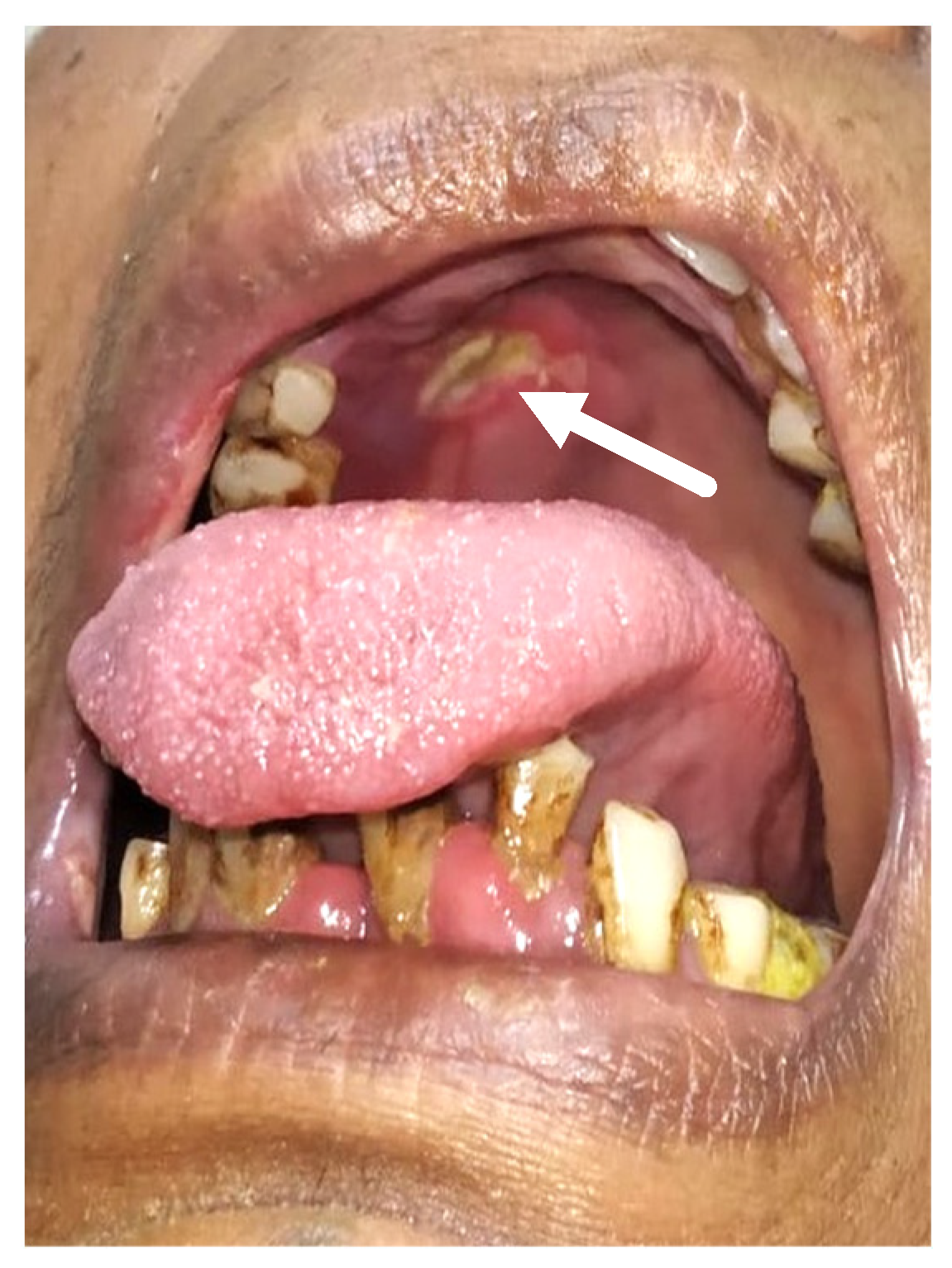 Healthcare | Free Full-Text | Oral Tissue Involvement and Probable Factors  in Post-COVID-19 Mucormycosis Patients: A Cross-Sectional Study