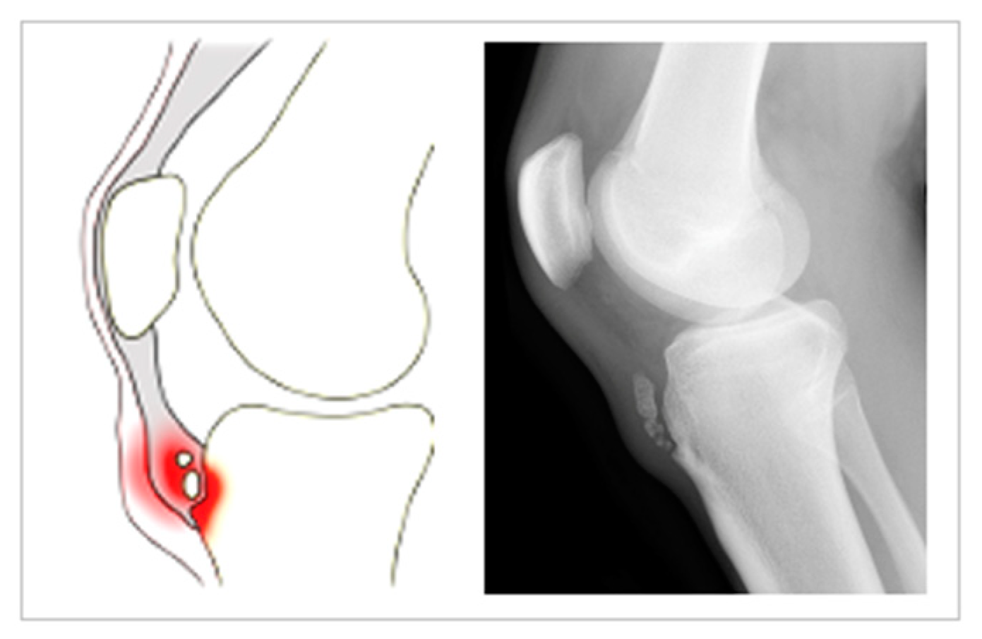 Healthcare | Free Full-Text | Osgood-Schlatter Disease: Appearance,  Diagnosis and Treatment: A Narrative Review