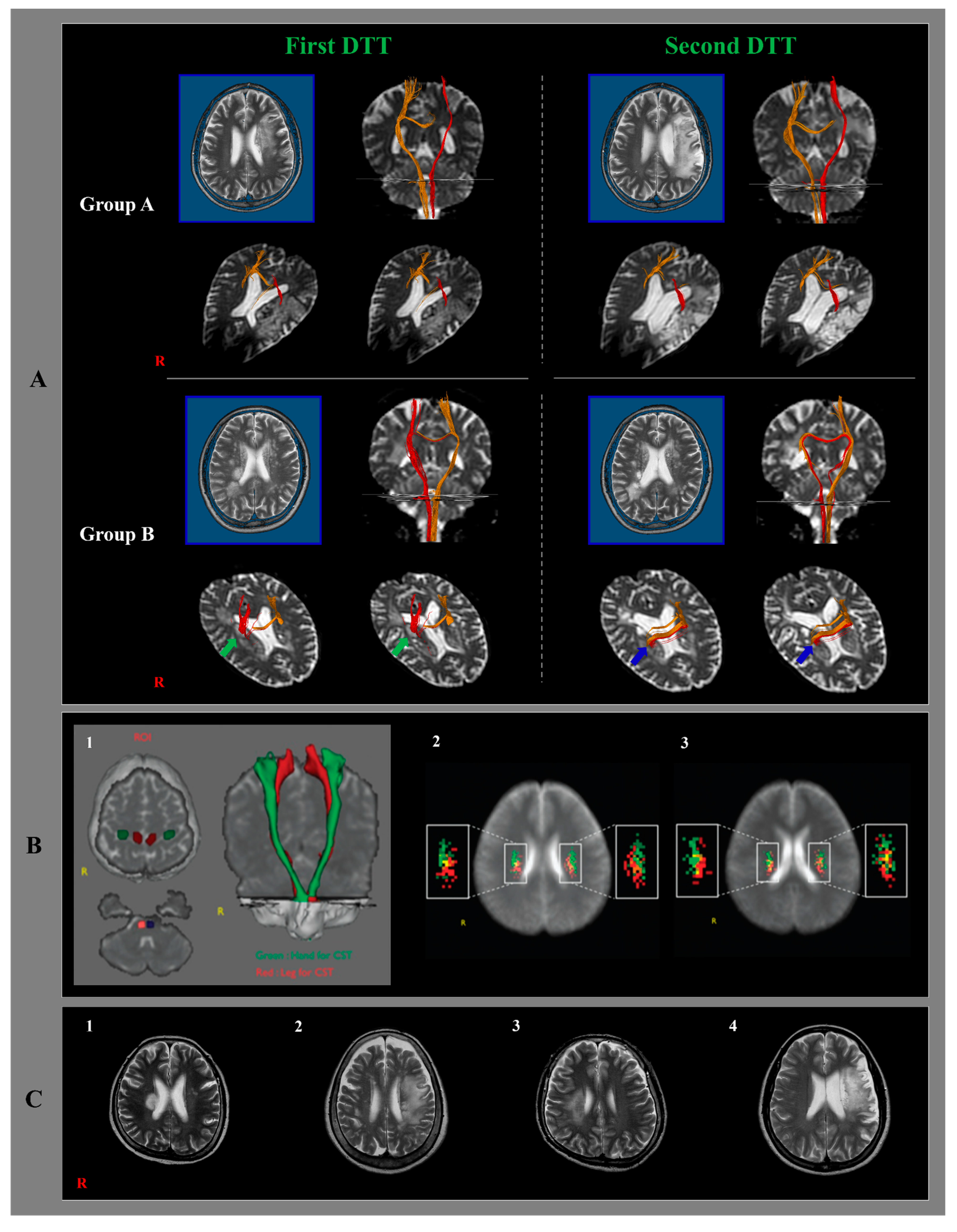 Healthcare Free Full-Text Prognosis of the Ipsilesional Corticospinal Tracts with Preserved Integrities at the Early Stage of Cerebral Infarction Follow Up Diffusion Tensor Tractography Study Adult Pic Hq