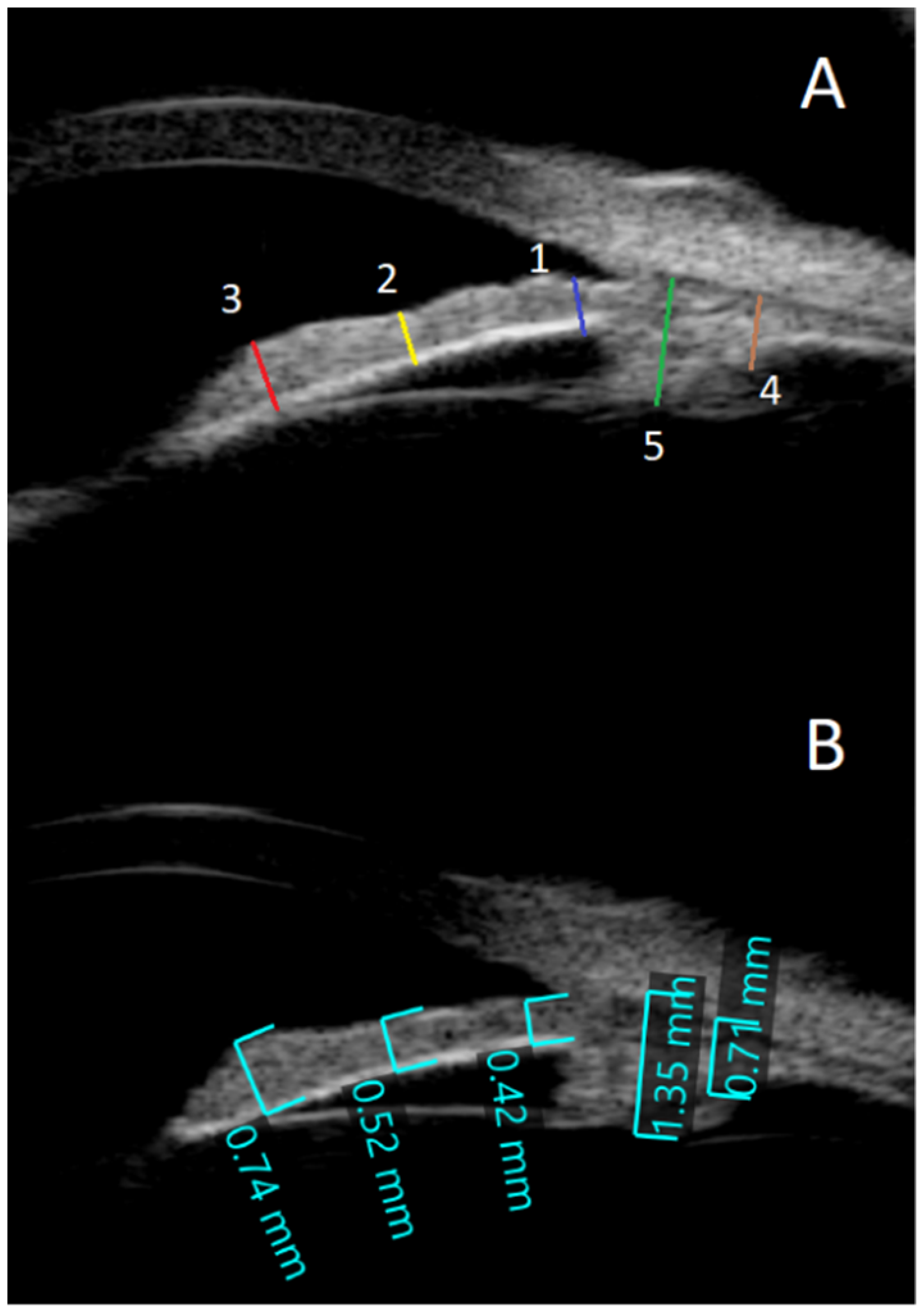 Healthcare | Free Full-Text | Anterior Ocular Biometrics as Measured by  Ultrasound Biomicroscopy | HTML