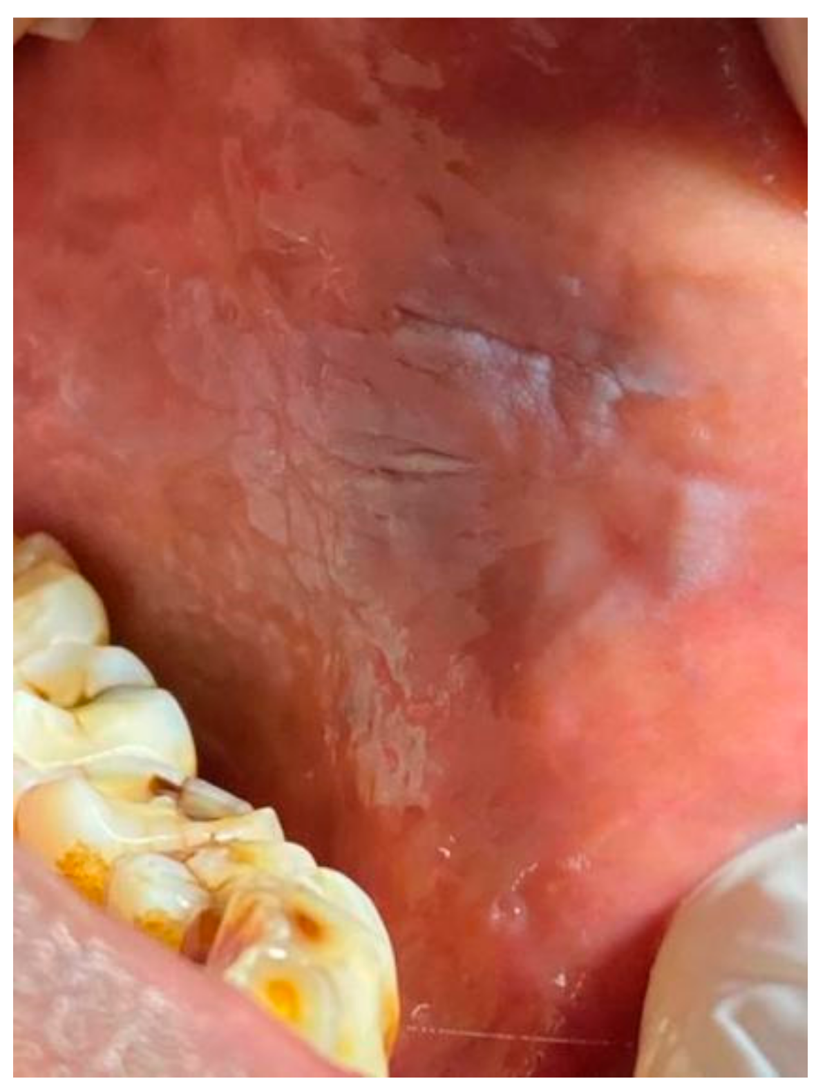 Tobacco Pouch Keratosis