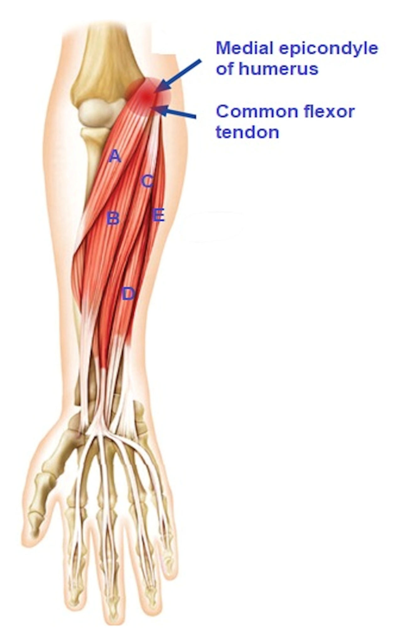 medial epicondyle of ulna