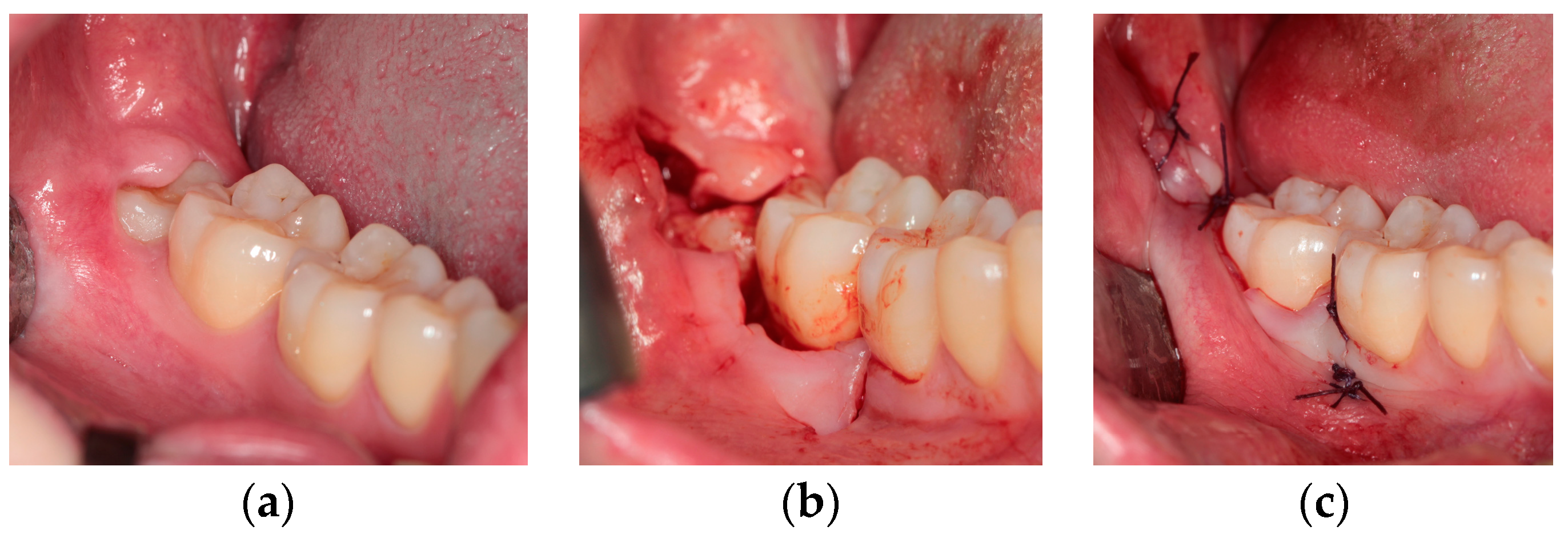 Third molar extraction deals