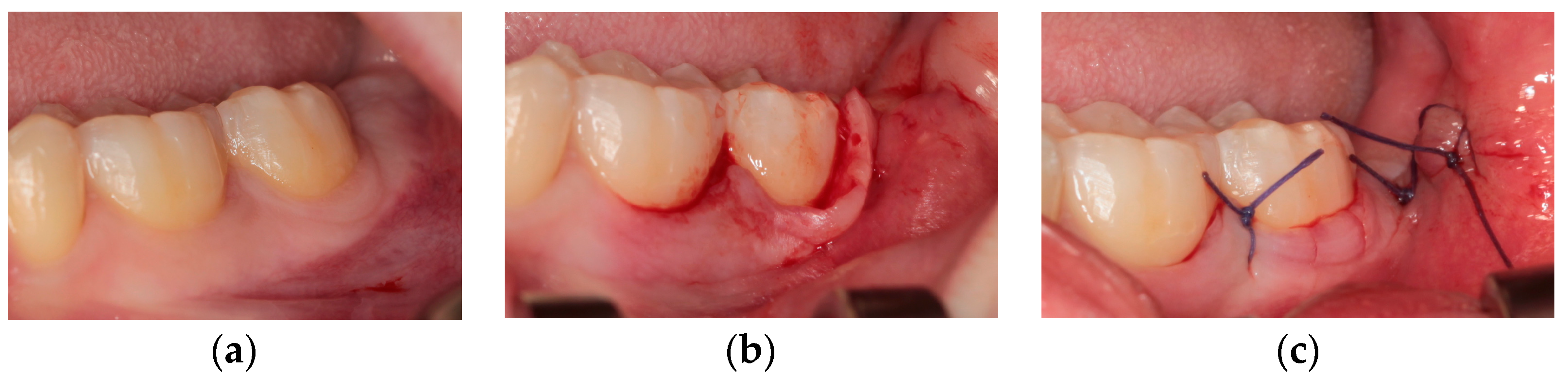 Periodontal Healing after Lower Third Molars Extraction: A Clinical ...