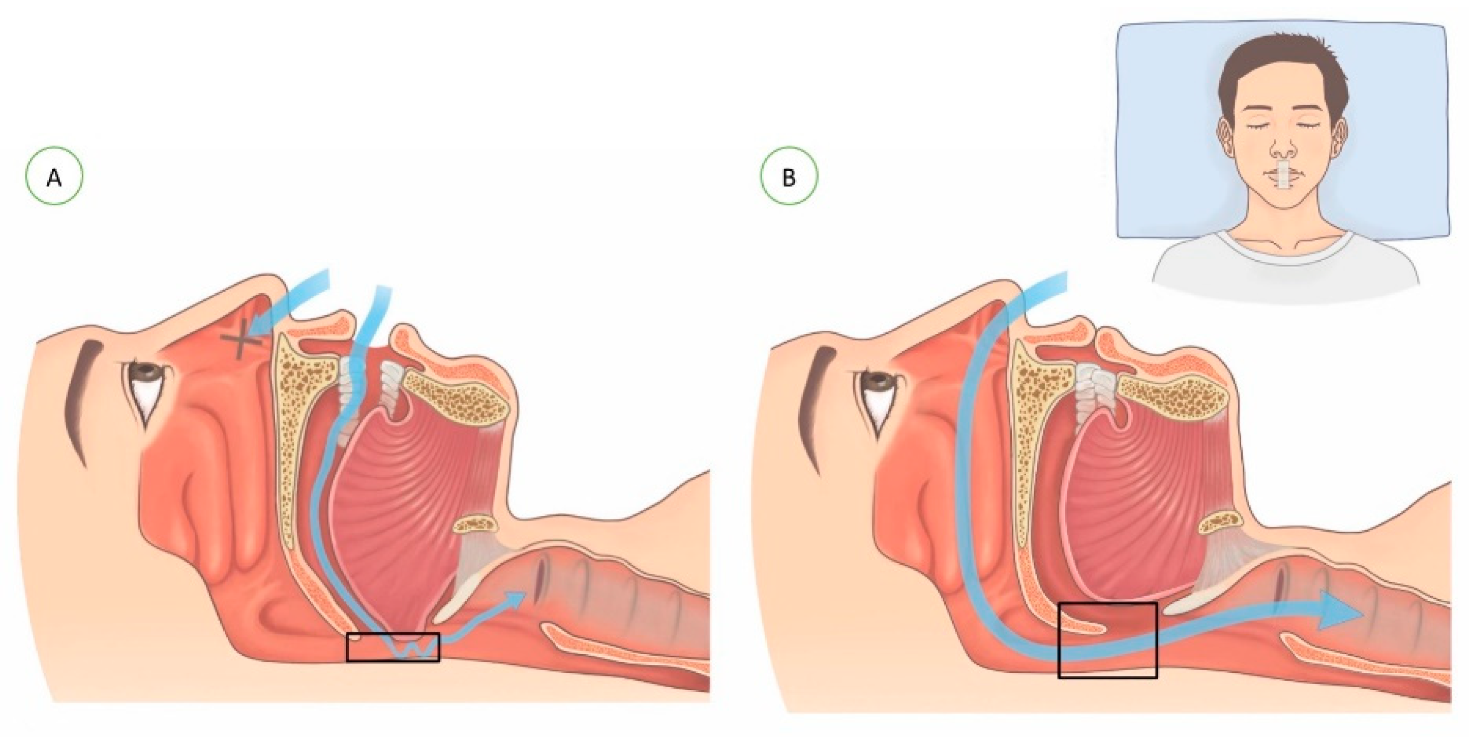 Is it safe to use mouth tape for sleeping?