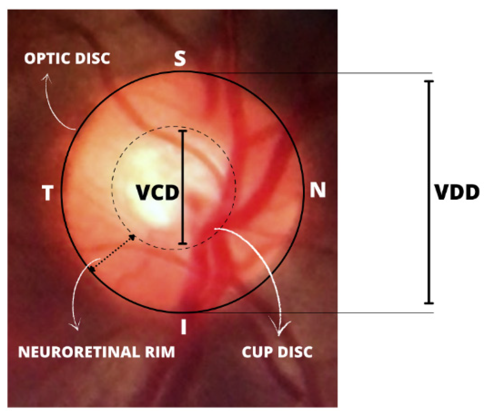 Healthcare Free FullText Detection of on Fundus Images