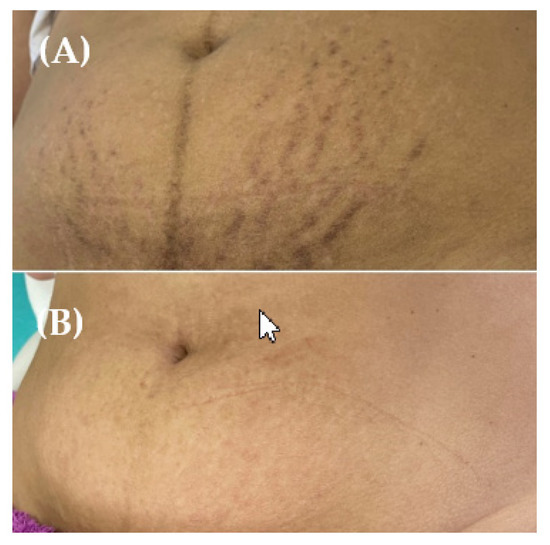 Fractional CO2 Laser versus Fractional Radiofrequency for Skin Striae Treatment Study Protocol