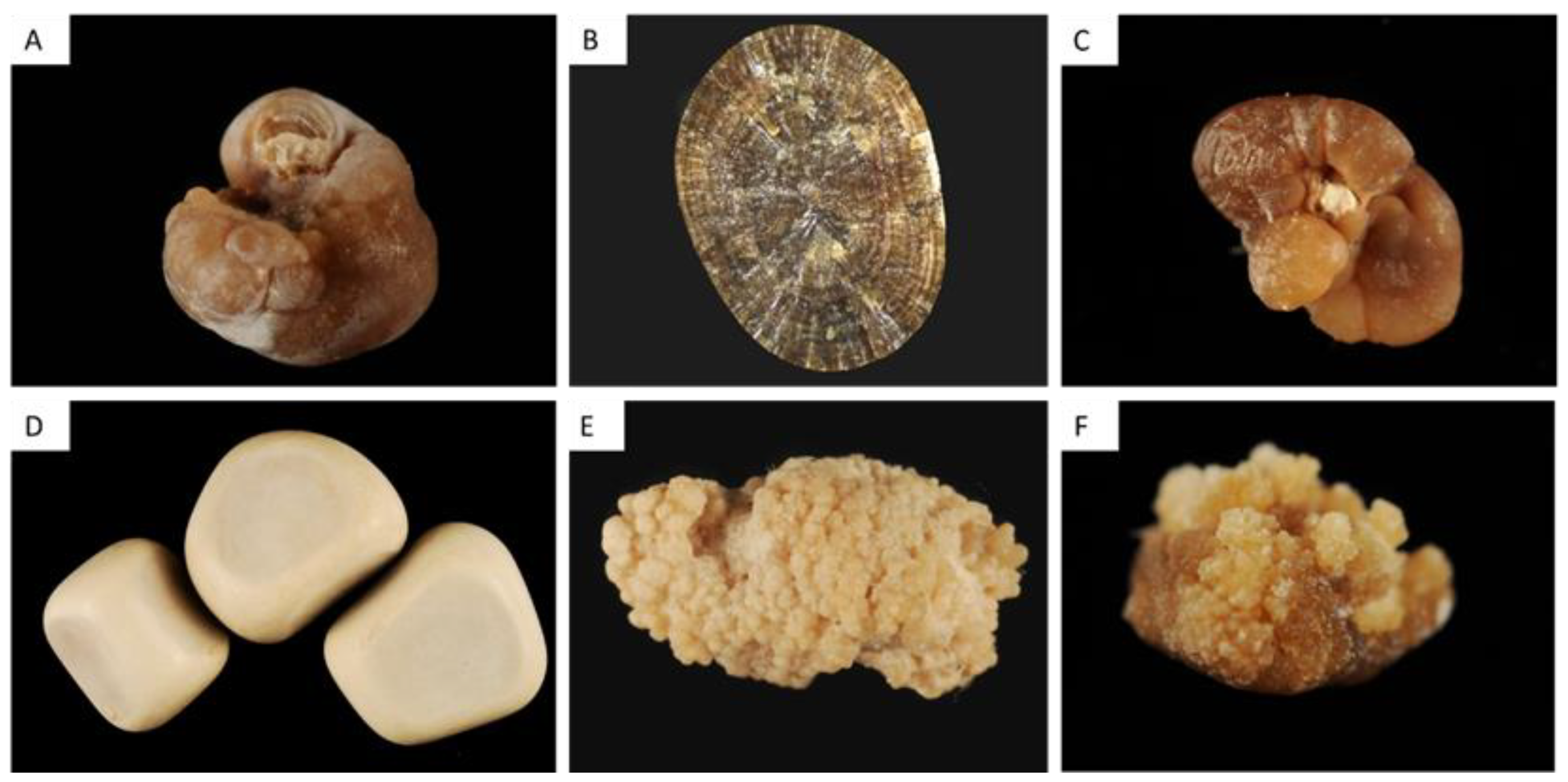Calcium Oxalate Kidney Stone