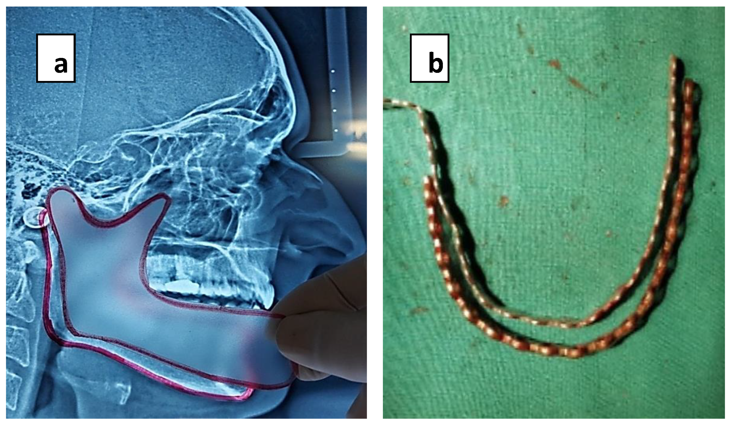 Asma Hayat Abad Sxe Xxx Video - Healthcare | Free Full-Text | Outcome Assessment after Reconstruction of  Tumor-Related Mandibular Defects Using Free Vascularized Fibular  Flap—A Clinical Study