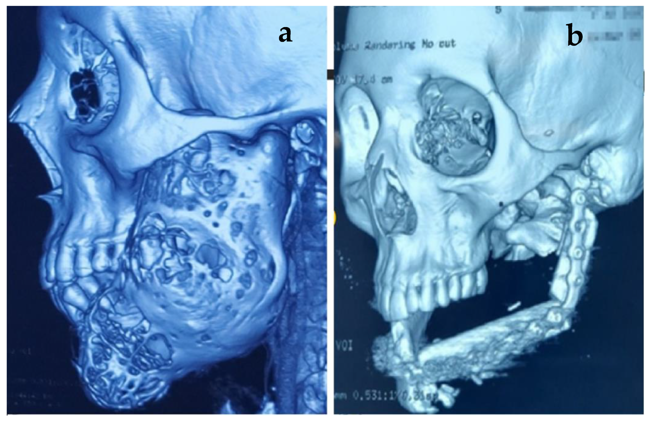 Asma Hayat Abad Sxe Xxx Video - Healthcare | Free Full-Text | Outcome Assessment after Reconstruction of  Tumor-Related Mandibular Defects Using Free Vascularized Fibular  Flap—A Clinical Study