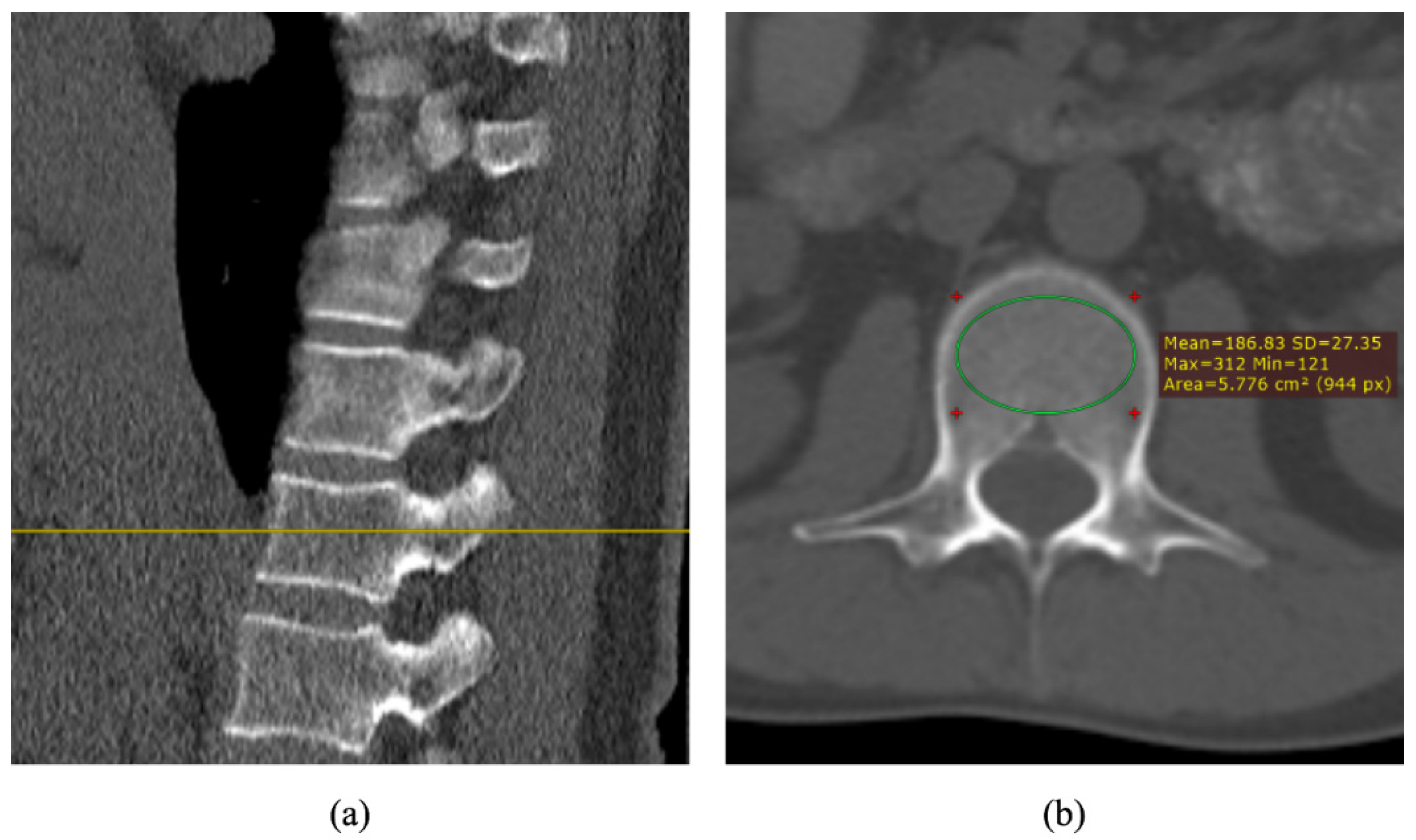 Severe osteoporosis x ray