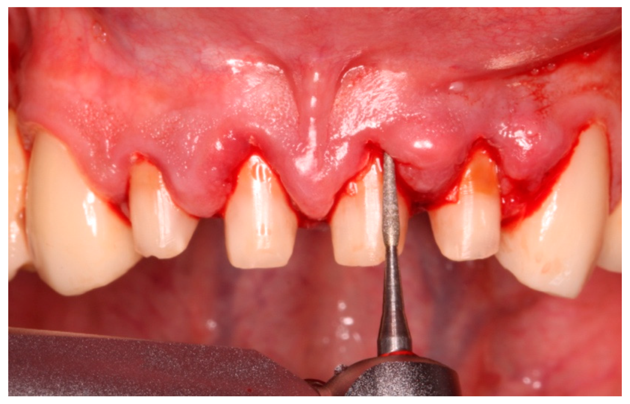 Healthcare Free FullText Periodontal Healing with Fixed