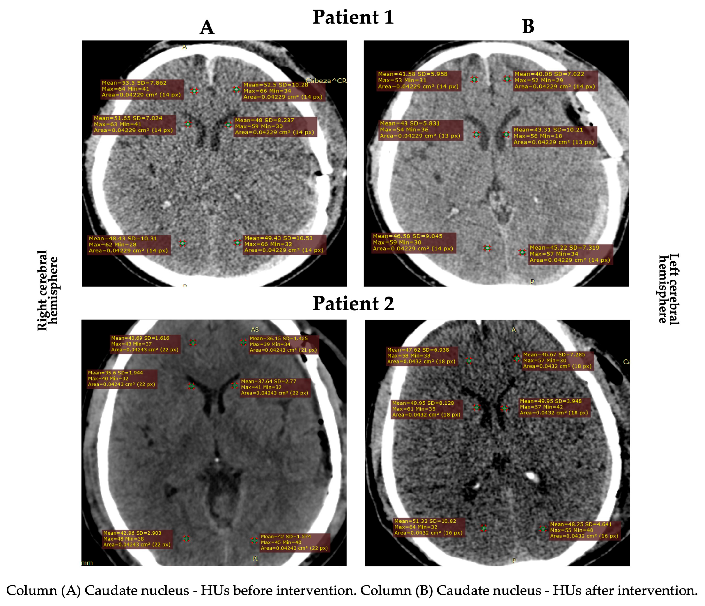 The Effect of Craniofacial Manual Lymphatic Drainage after