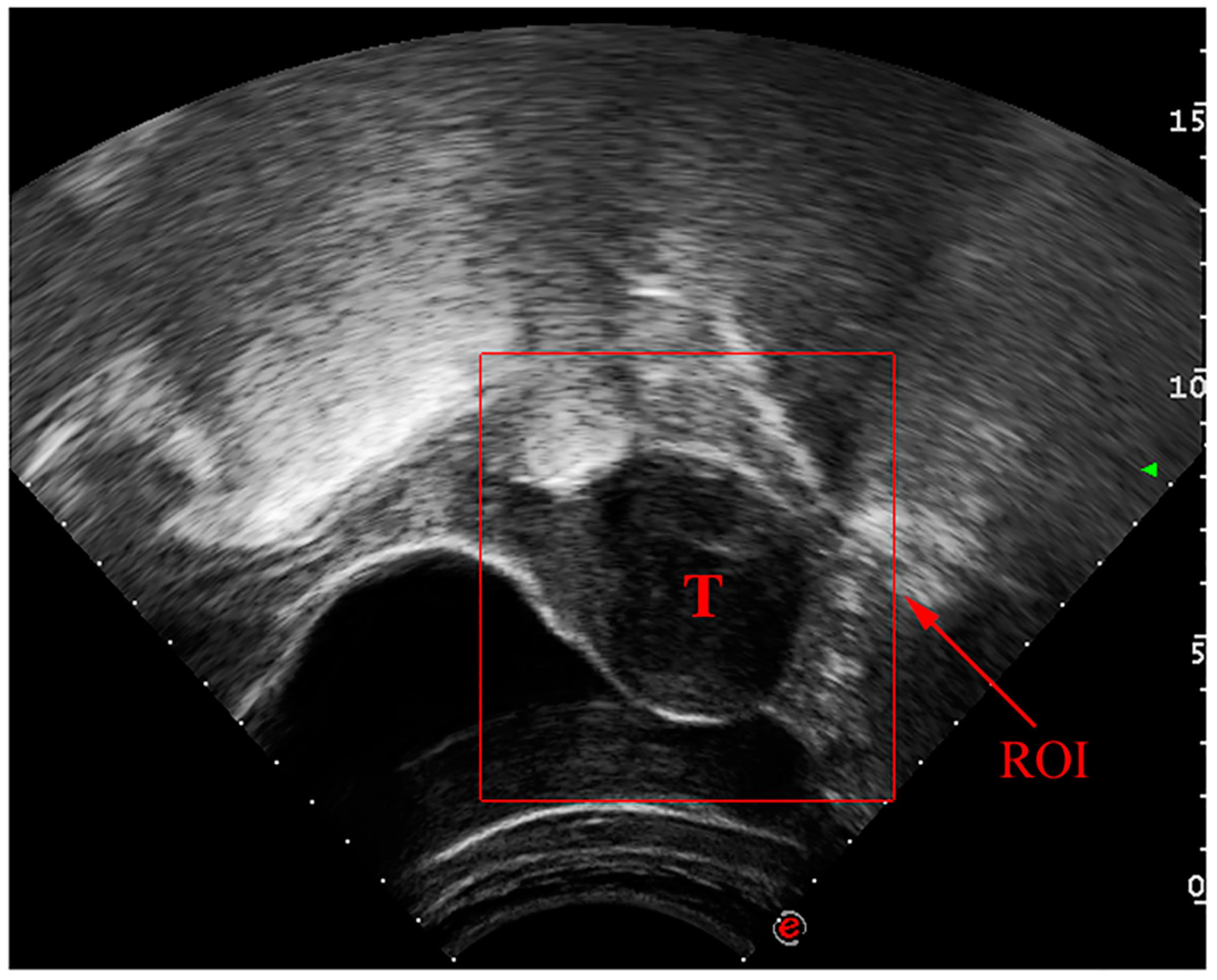 Uterine Fibroids Ultrasound uterine-fibroids-ultrasound