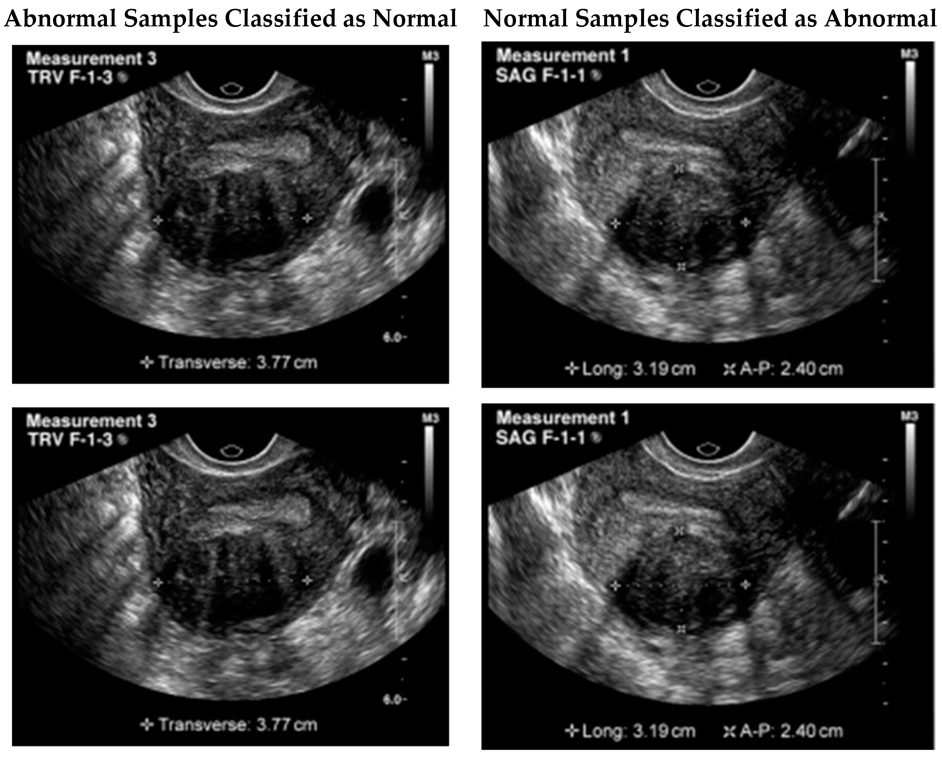 Healthcare free full text automated uterine fibroids detection in