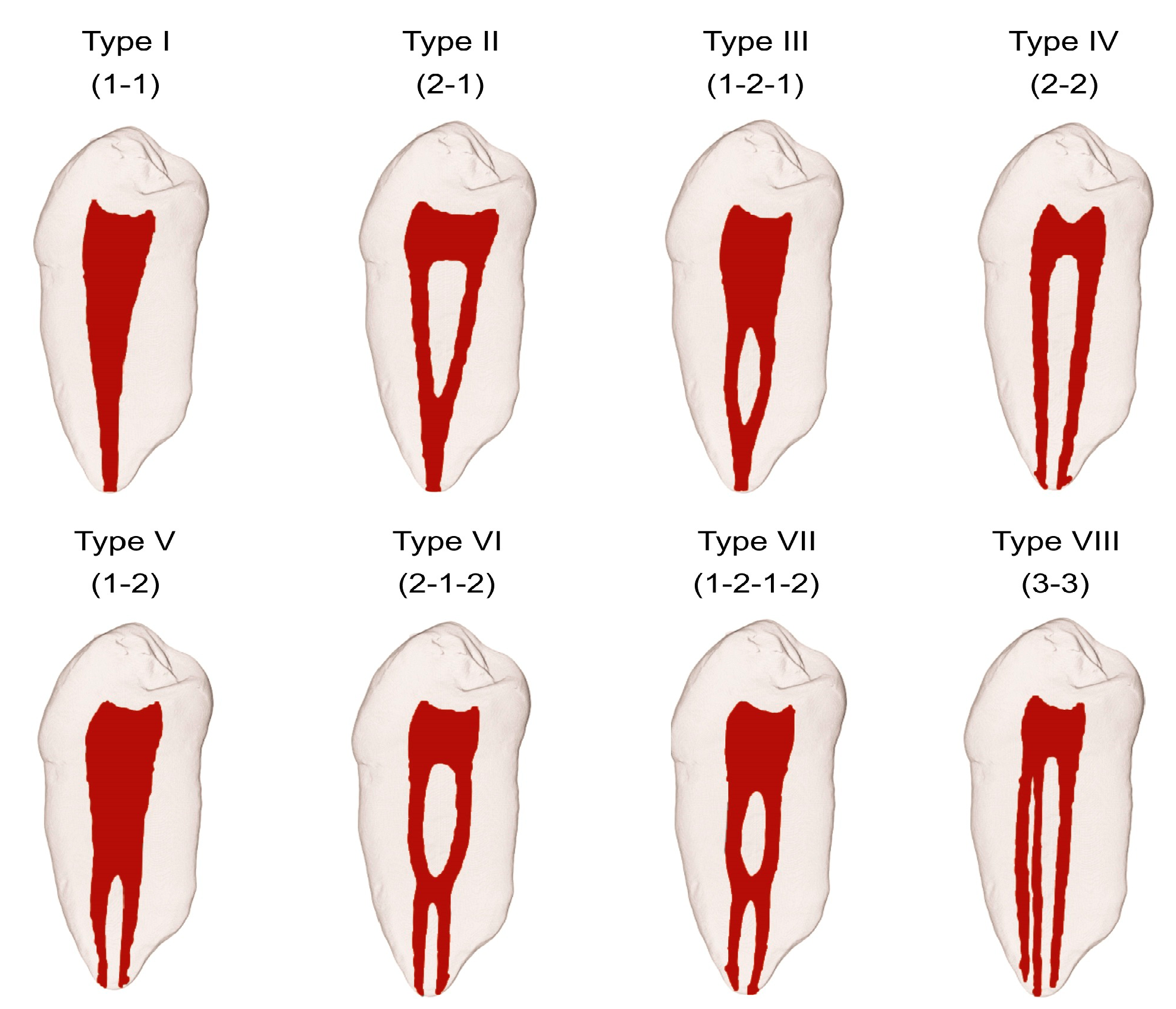Endodontic Management of ThreeRooted Mandibular Second Molar with