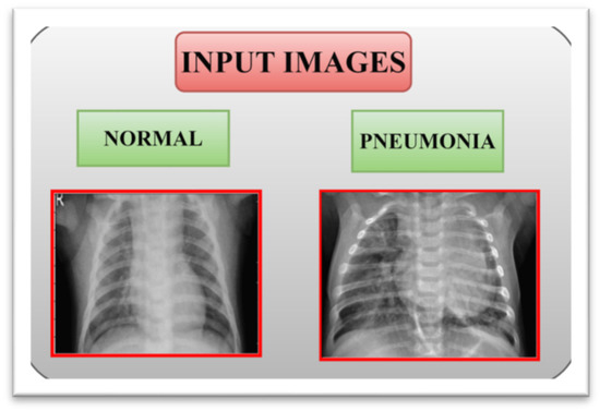 Healthcare | Free Full-Text | Detection of Pneumonia from Chest X-ray ...