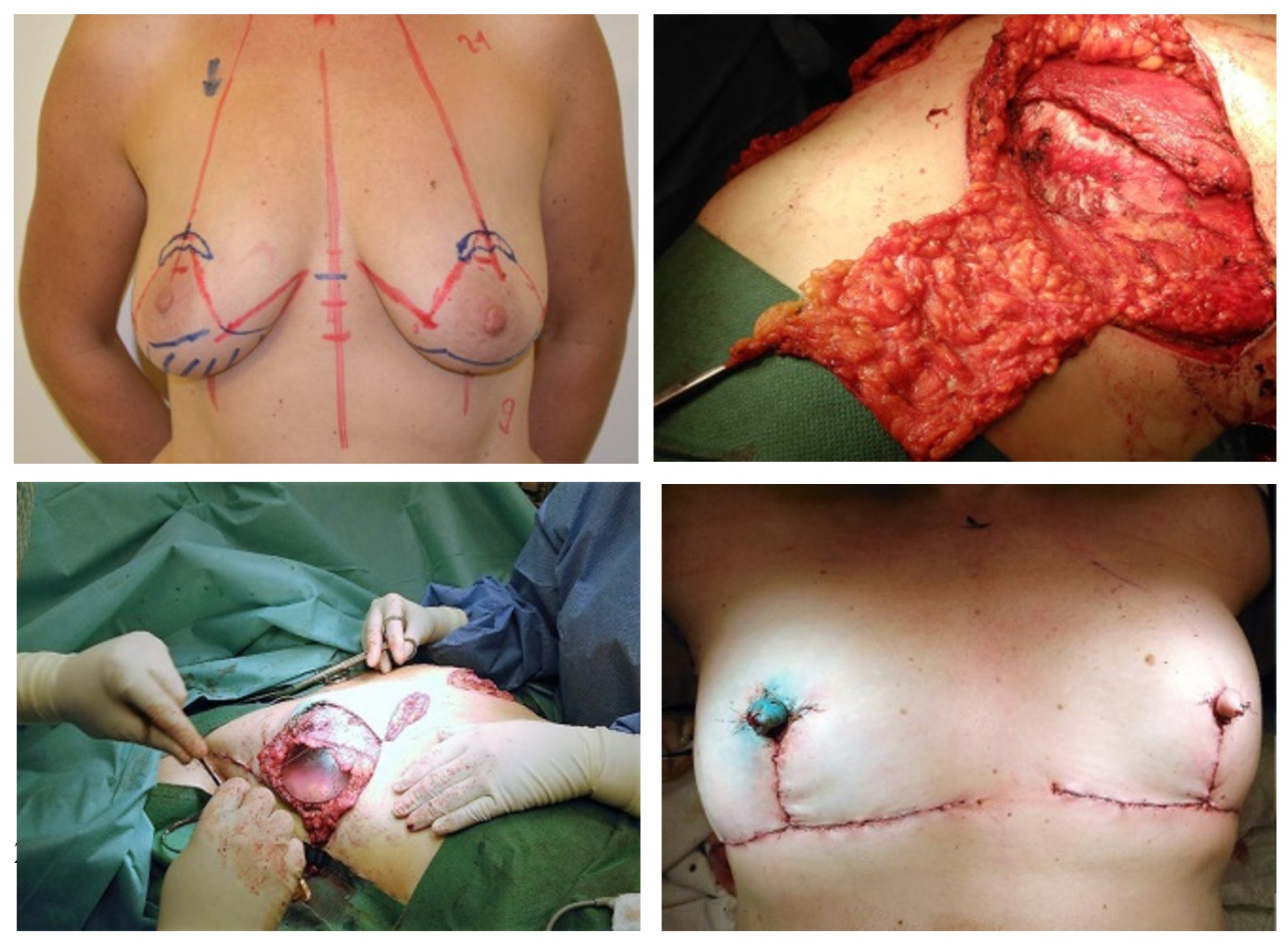 Breast Reconstruction After Mastectomy