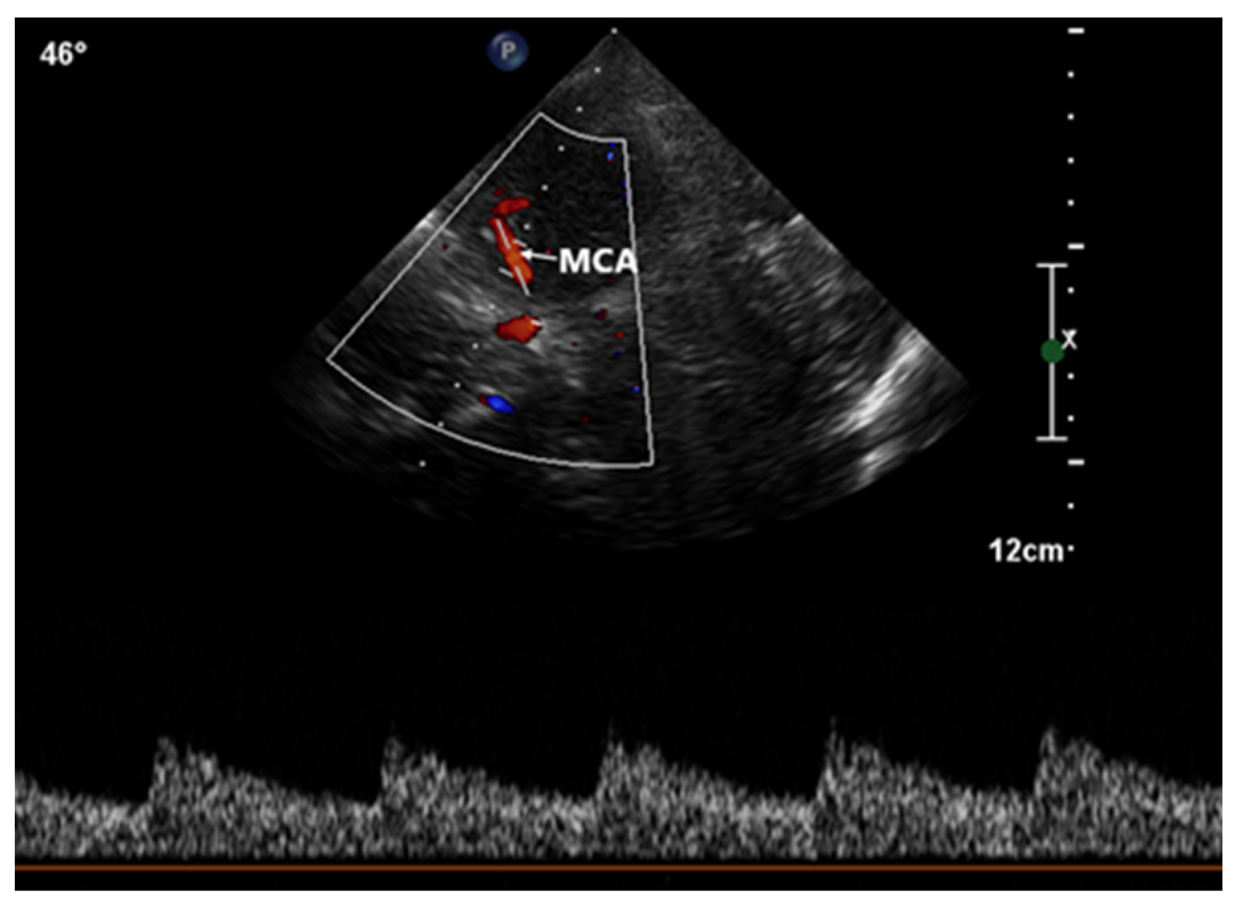 Healthcare Free FullText RighttoLeft Shunt Evaluation in Cardiac