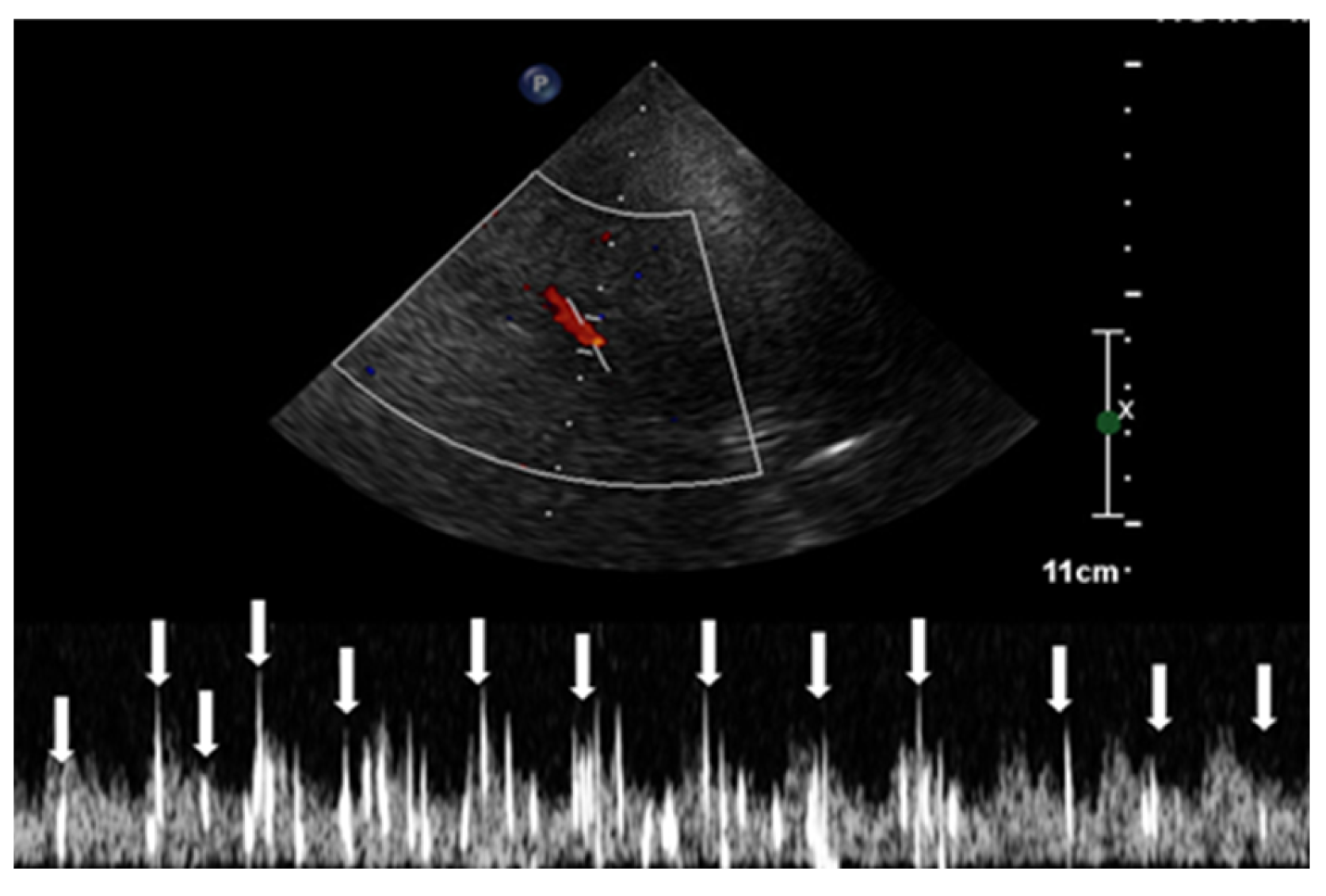 Healthcare Free FullText RighttoLeft Shunt Evaluation in Cardiac