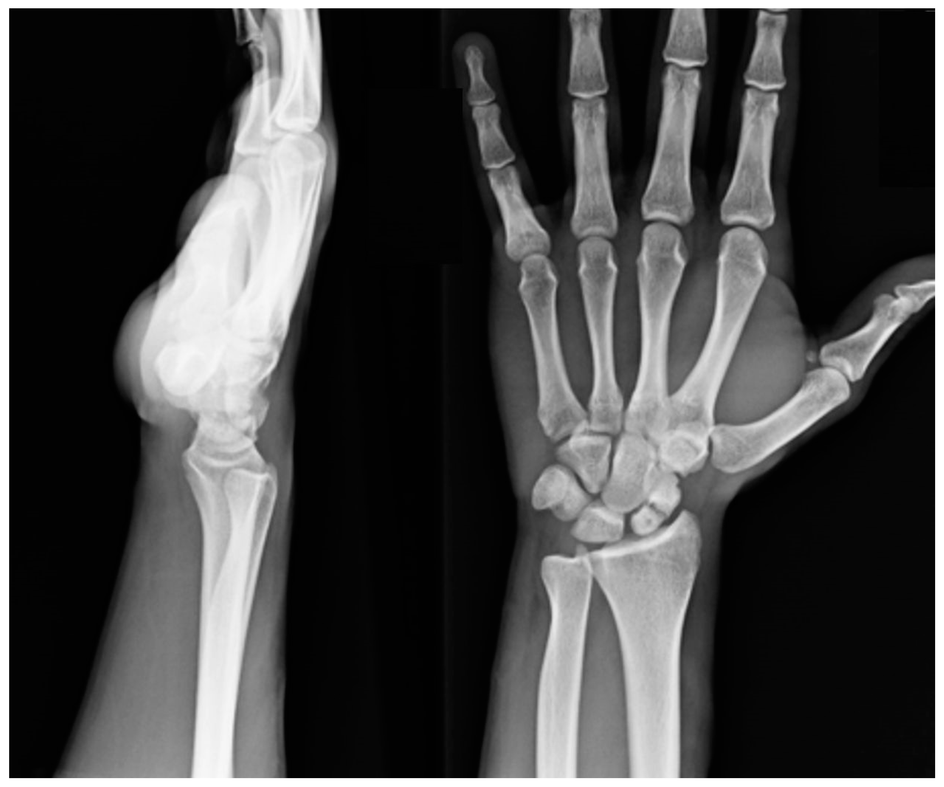 Healthcare | Free Full-Text | Treatment of Scaphoid Non-Unions with  Custom-Made 3D-Printed Titanium Partial and Total Scaphoid Prostheses and  Scaphoid Interosseous Ligament Reconstruction