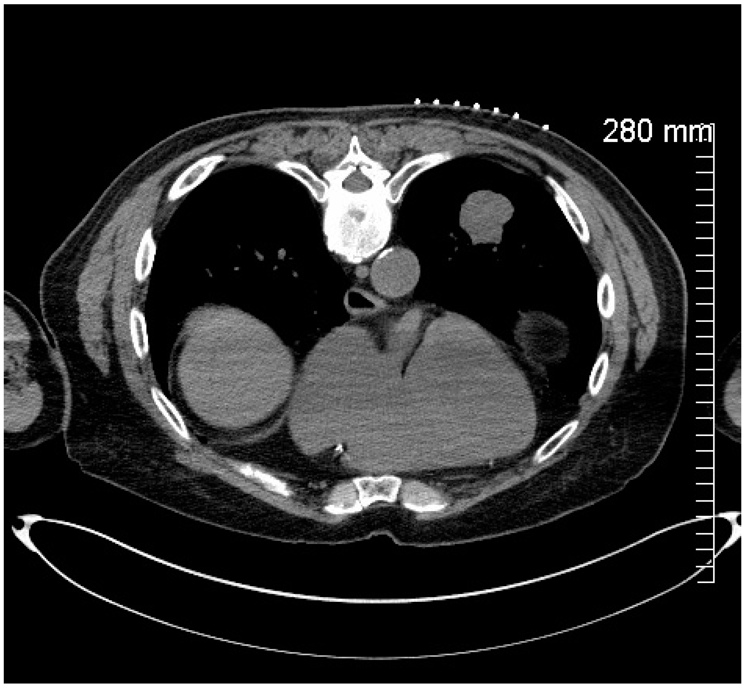 健康・医学 high-resolution CT of the lung High-Resolution CT of the Lung: 9781451176018: Medicine
