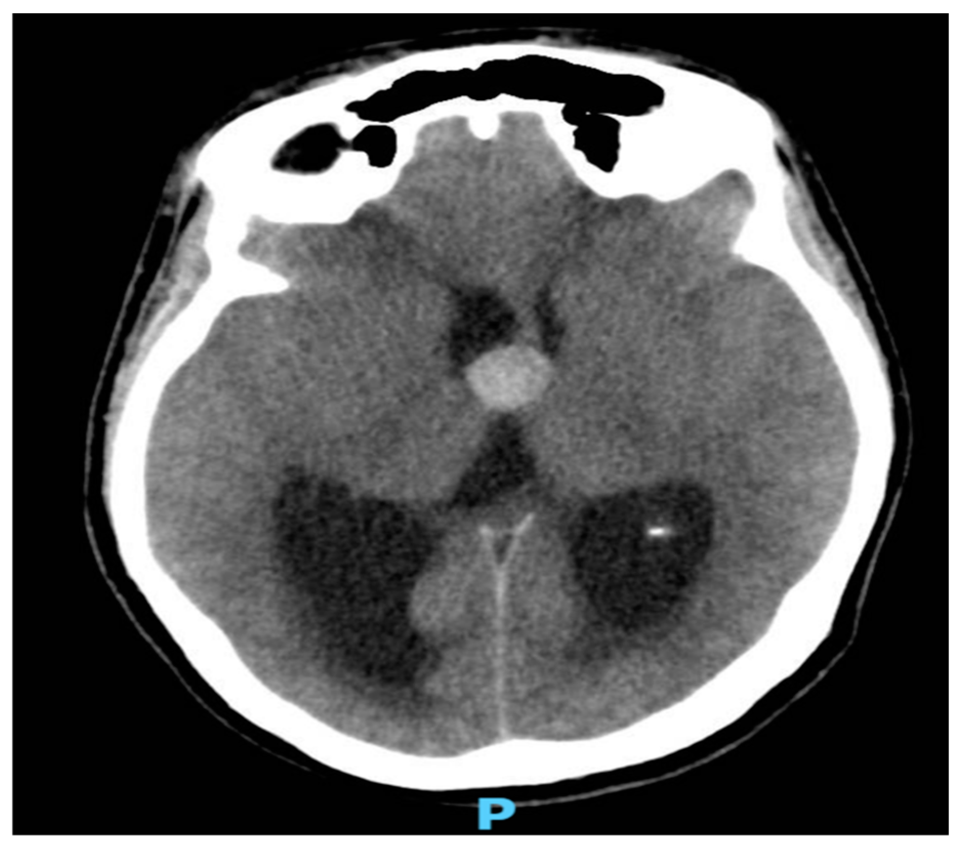 Rapid Deterioration and Fatal Outcomes in Colloid Cyst