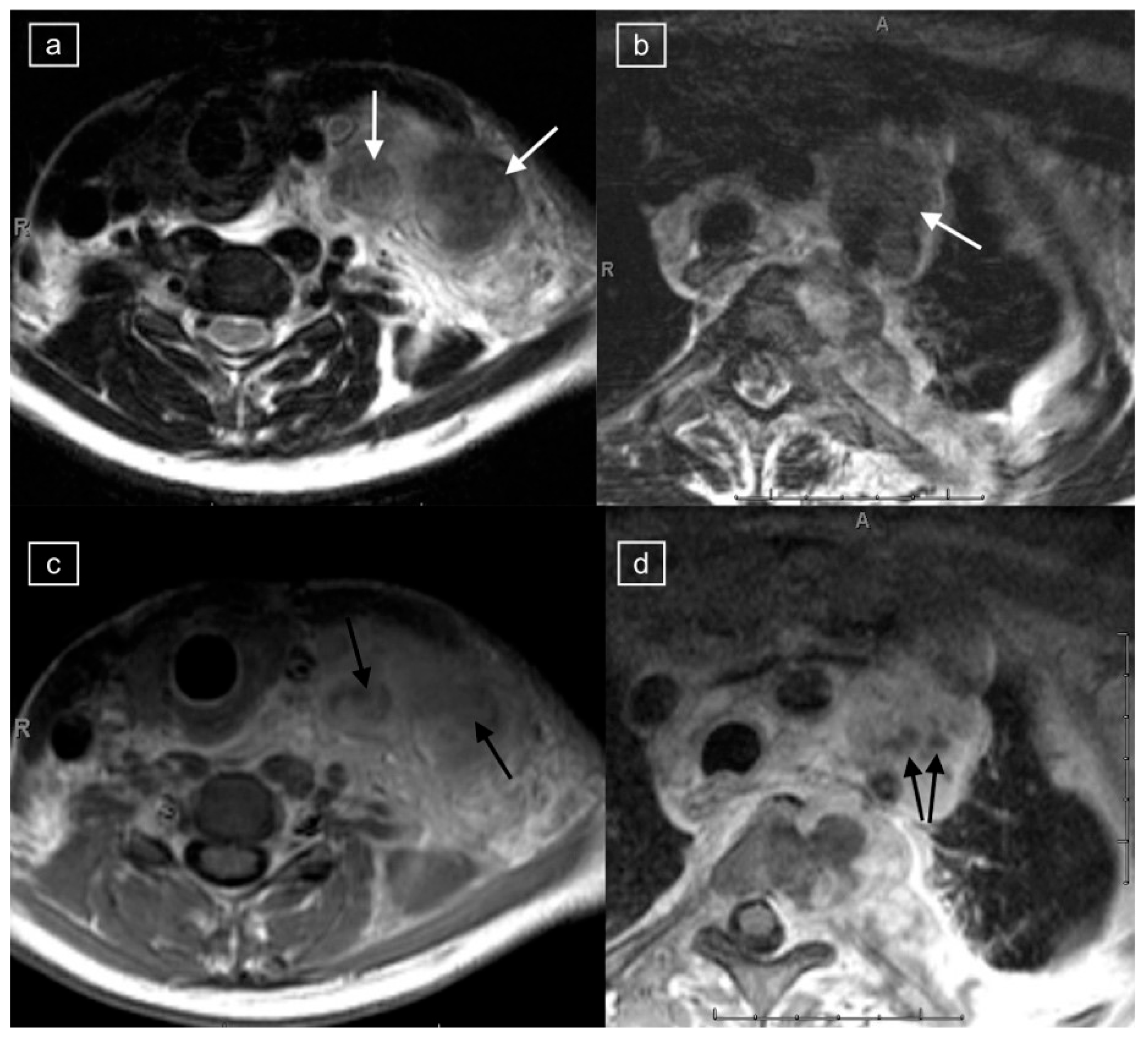 Unusual Signal of Lymphadenopathy in Children with Nodular