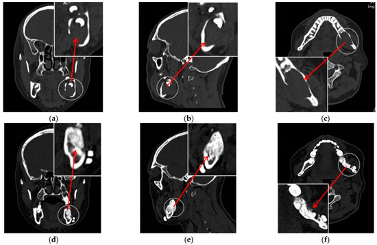 Hyperbaric Oxygen Therapy as a Renewed Hope for Ischemic