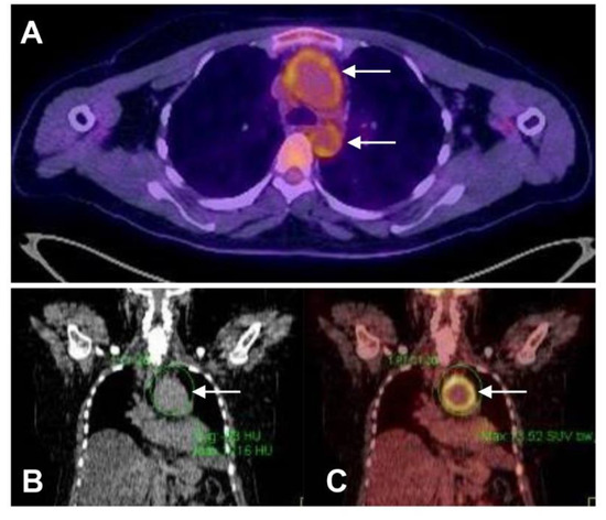 Intervention in Takayasu Aortitis: When, Where and How?
