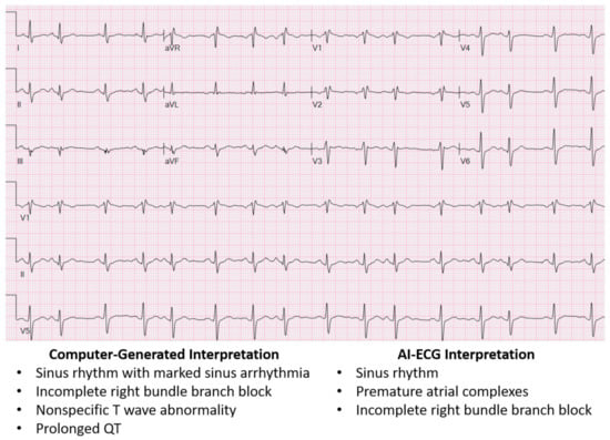 Comparing Personal EKGs: What you need to know