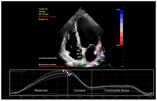 Linking Epicardial Adipose Tissue to Atrial Remodeling