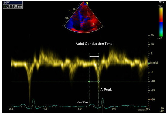Linking Epicardial Adipose Tissue to Atrial Remodeling