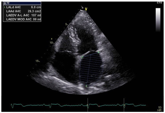 Linking Epicardial Adipose Tissue to Atrial Remodeling