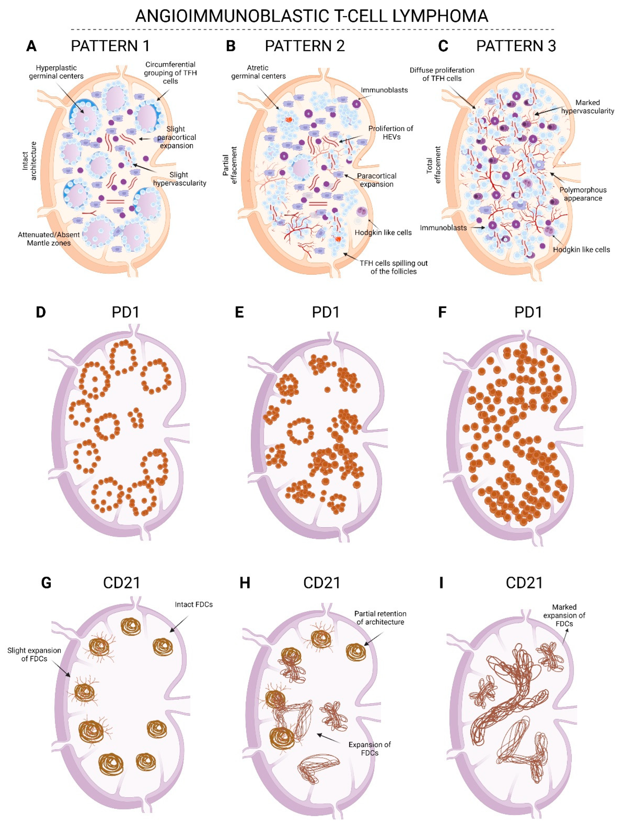Hemato | Free Full-Text | Peripheral T-Cell Lymphomas of the T