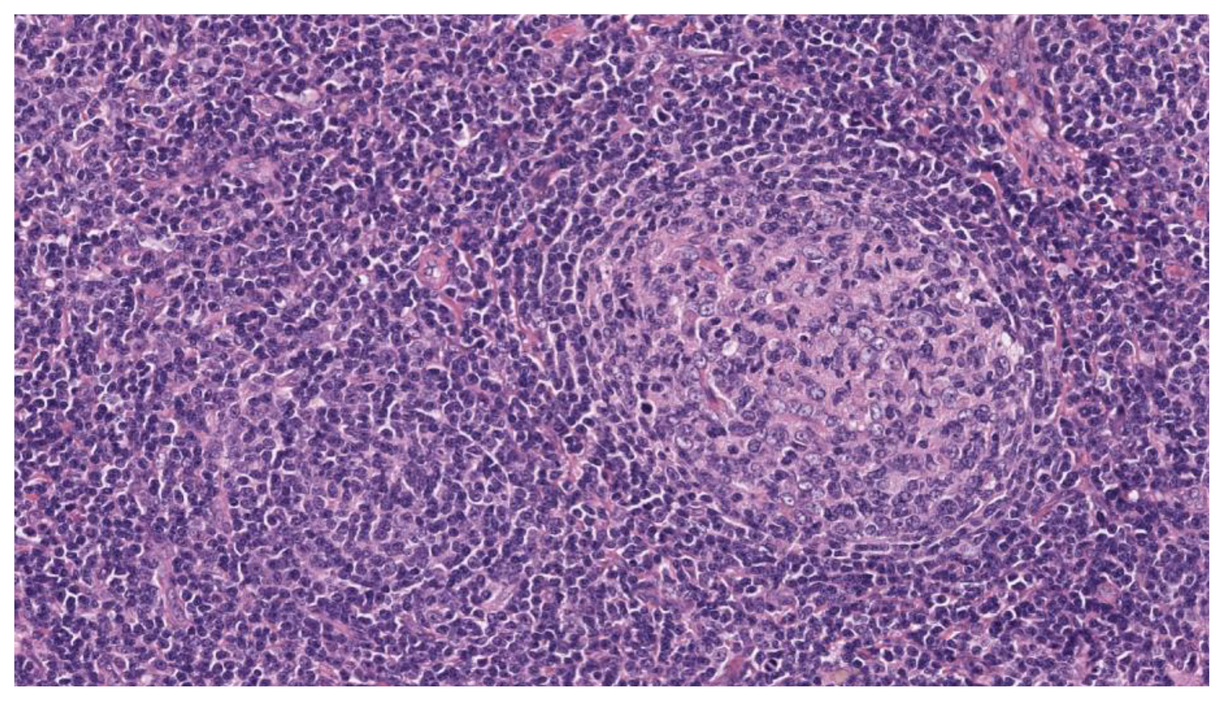 B Lymphoproliferative Neoplasms of Uncertain Biological