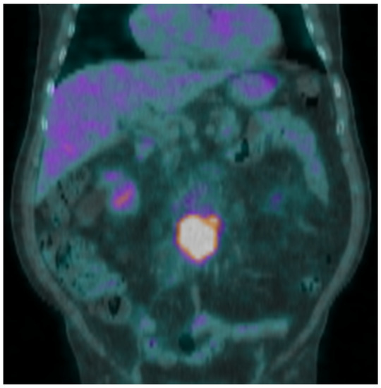 Hemato Free FullText Imaging of Vascular Graft/Endograft Infection with Radiolabeled White