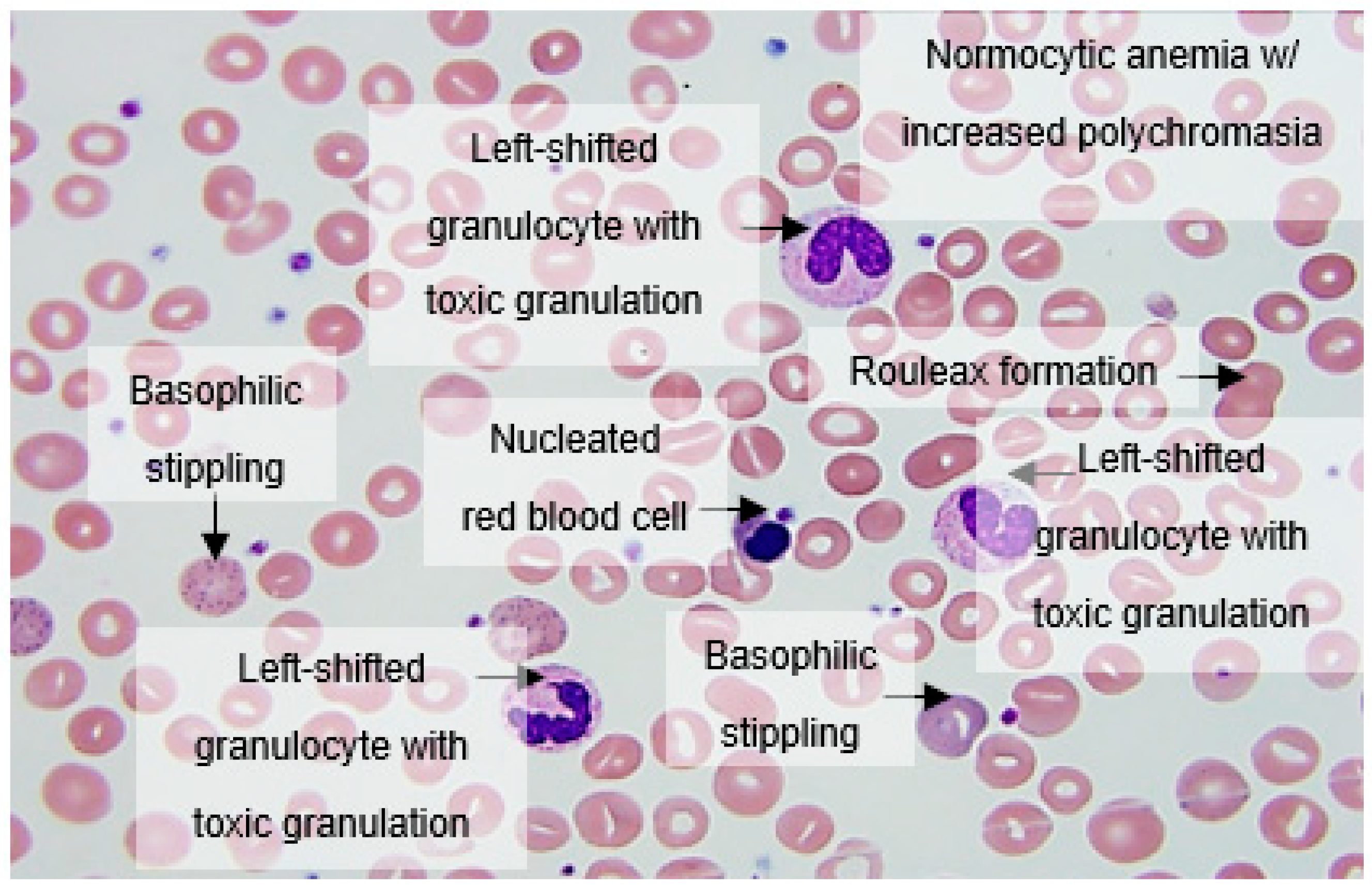 Hematologic Complications in Patients Hospitalized with COVID19 Infection