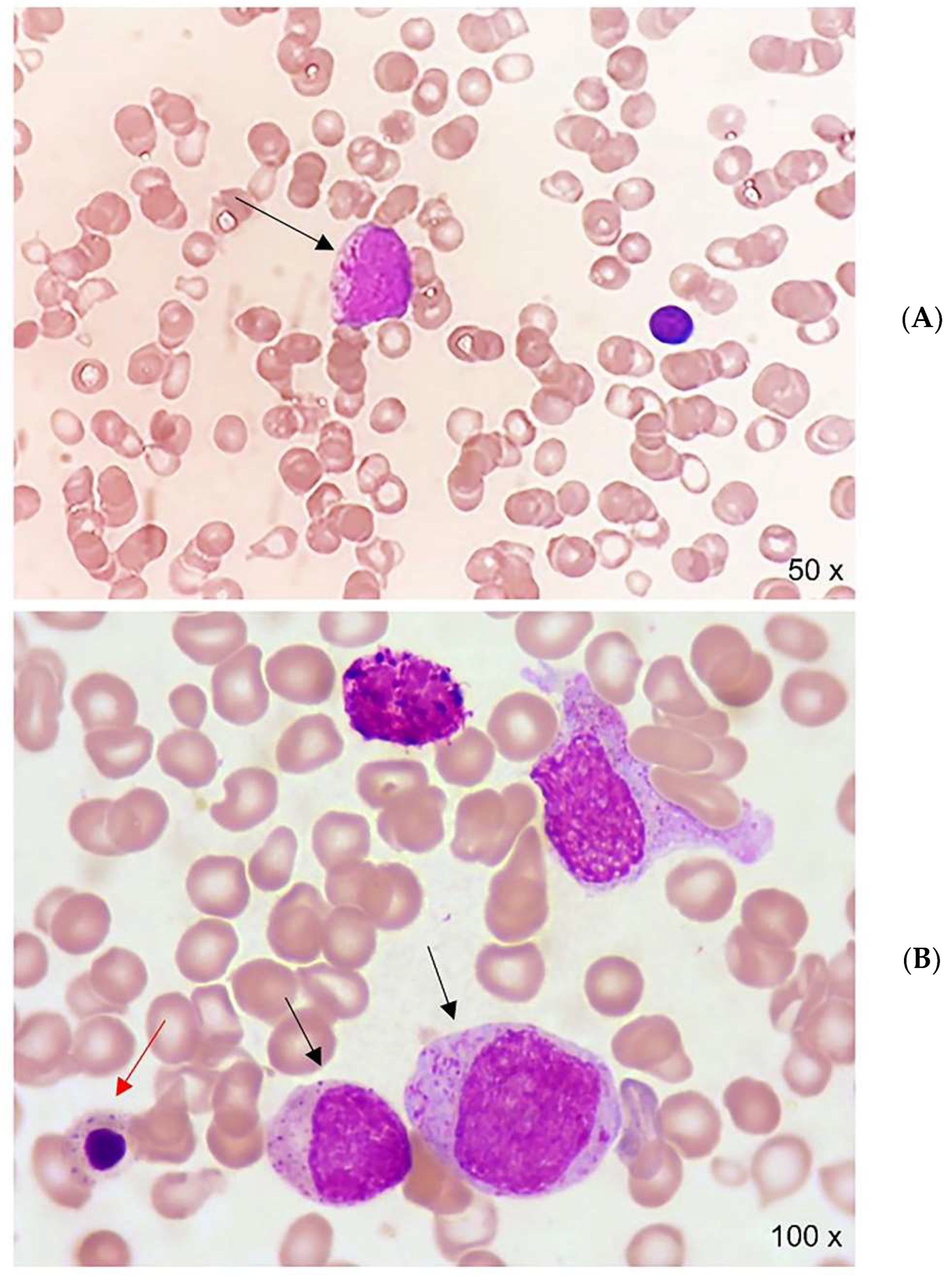 Hematolrep 14 00045 g001 Hematolrep 14 00045 g001