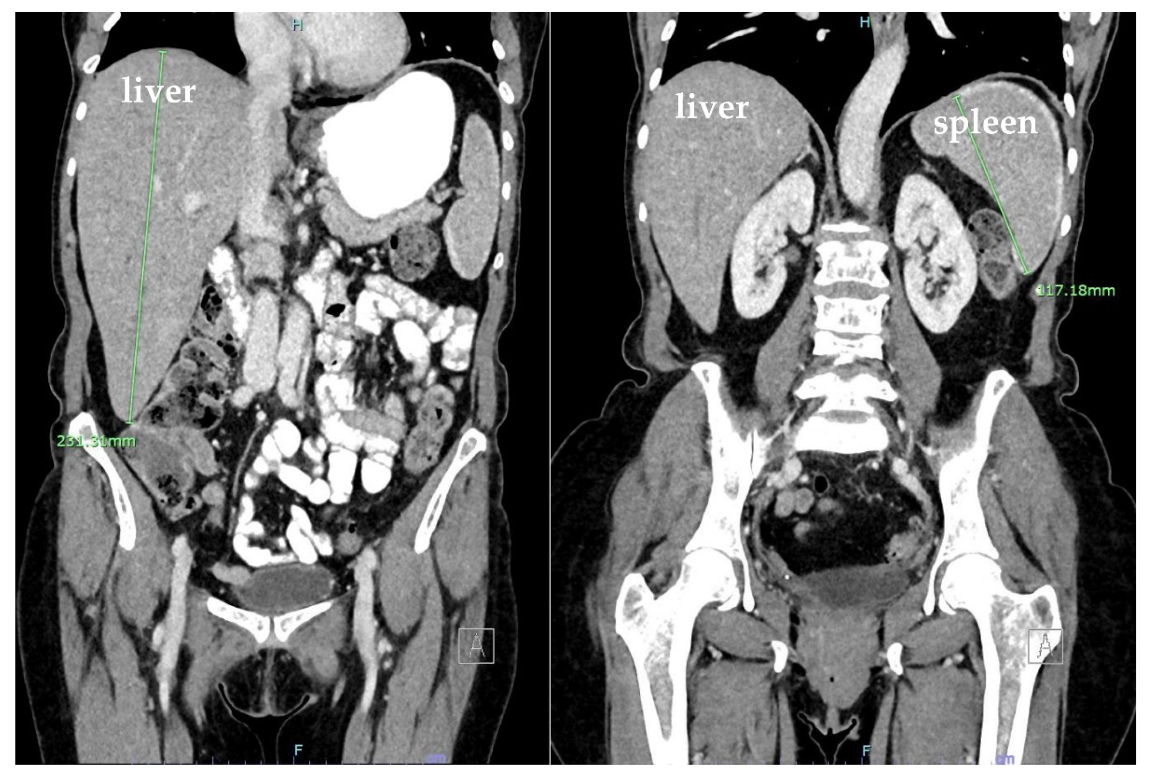 Hematolrep 15 00038 g002 Hematolrep 15 00038 g002