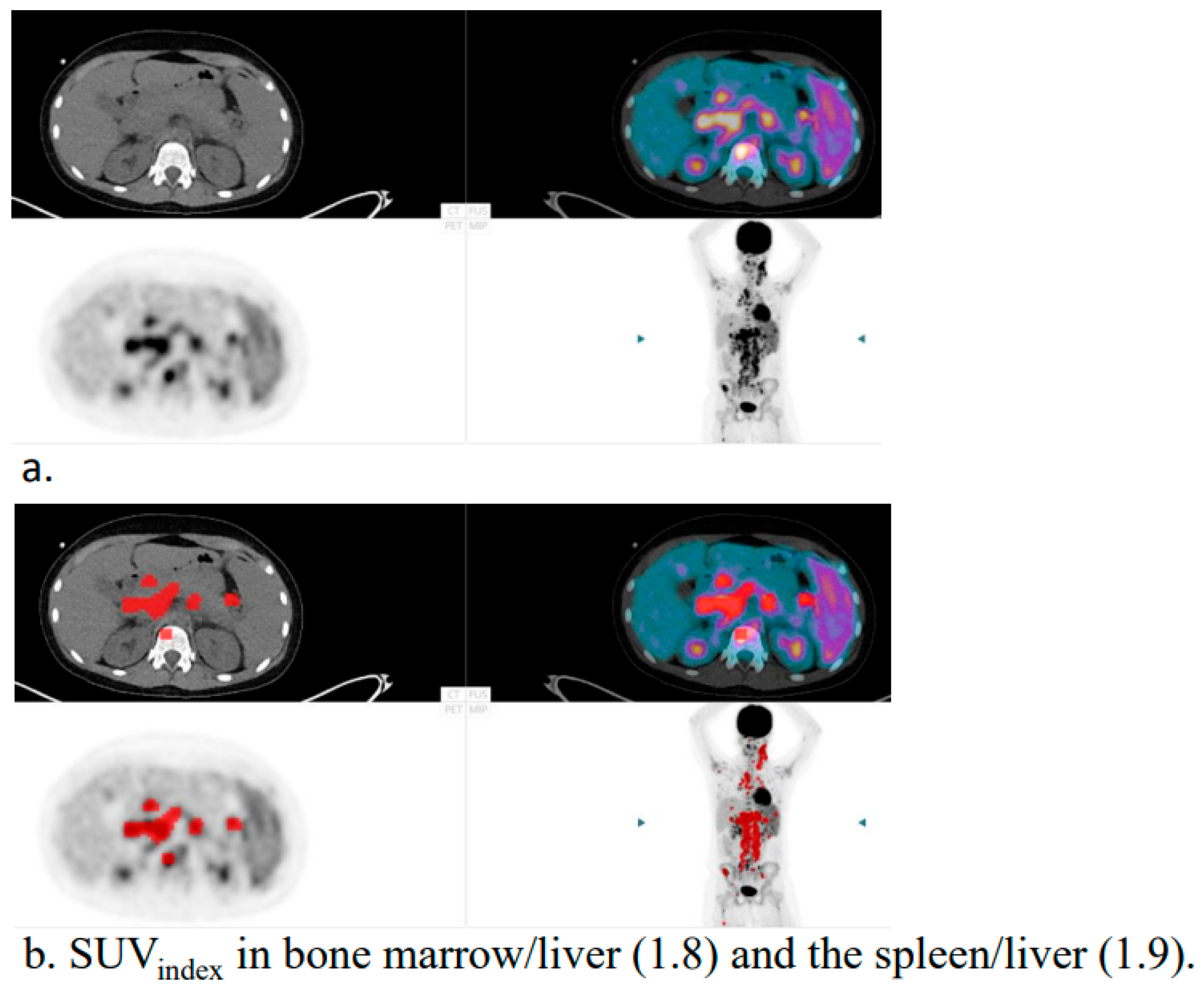 Hematolrep 17 00060 g001 Hematolrep 17 00060 g001