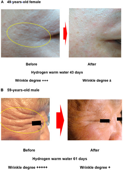 Repetitive Bathing and Skin Poultice with Hydrogen-Rich Water 