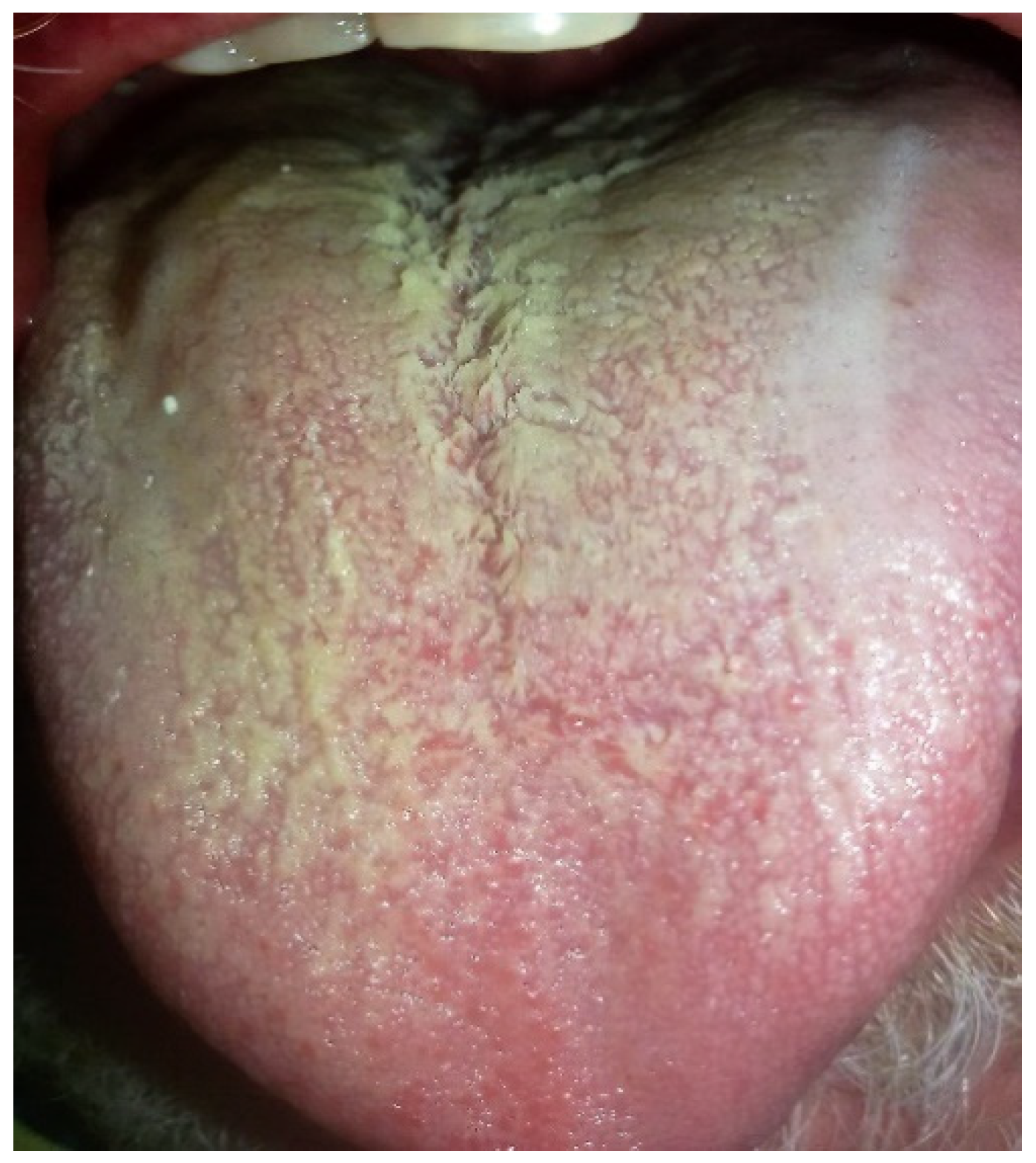 Bacteria On Tongue