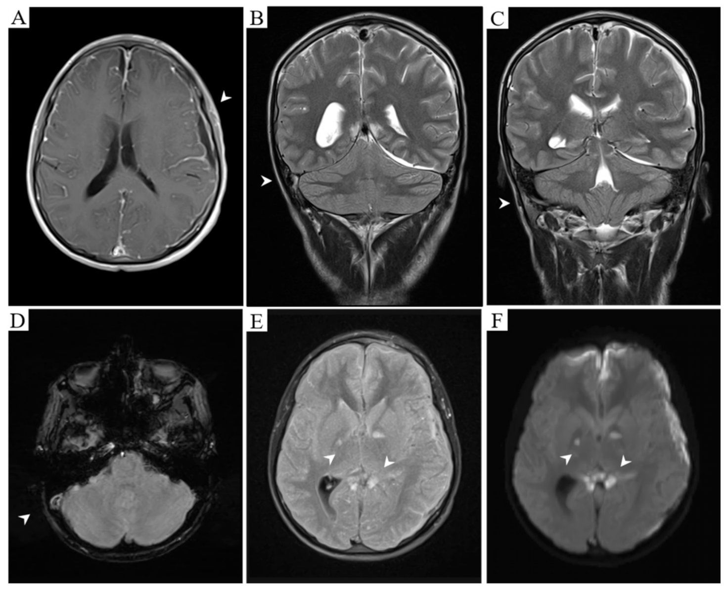 Atypical Streptococcal Meningitis with Fatal Cerebrovascular