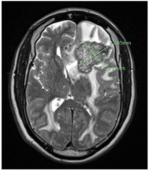 Intracranial Tuberculoma Mimicking Neurosarcoidosis: A