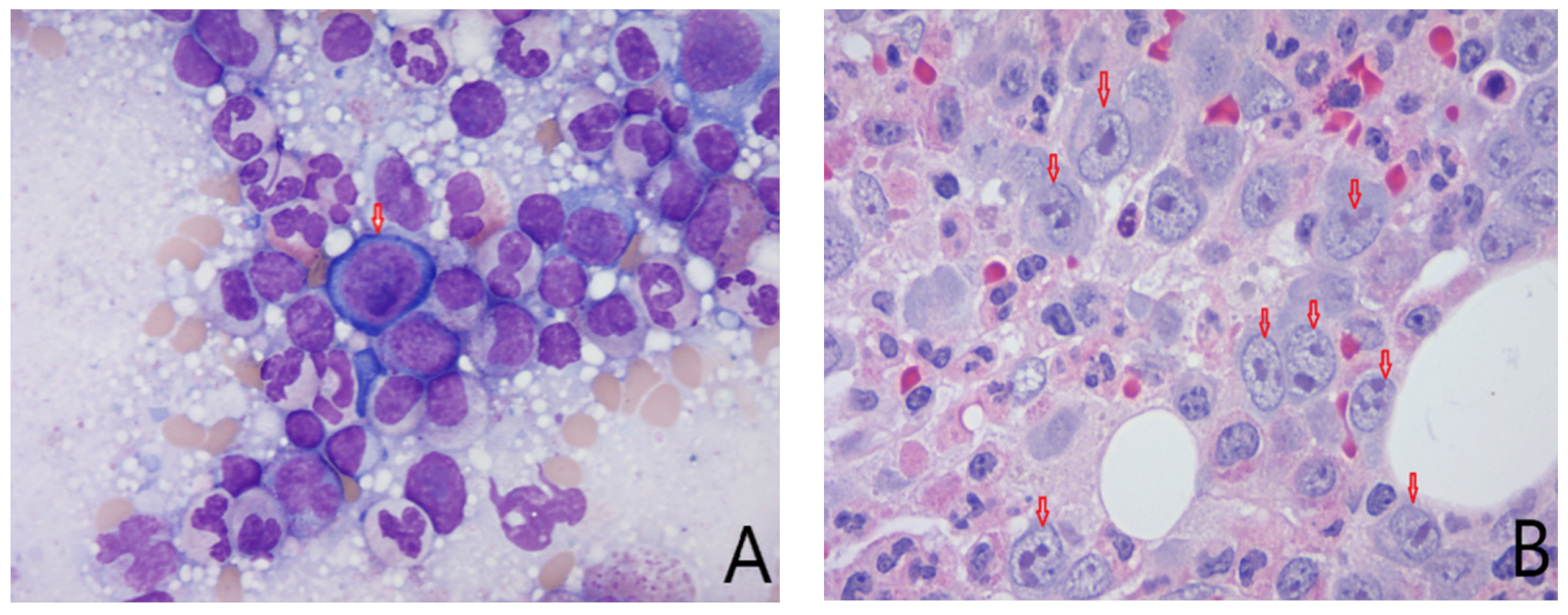 Toxin-Mediated Myocarditis From a Brown Recluse Spider Bite